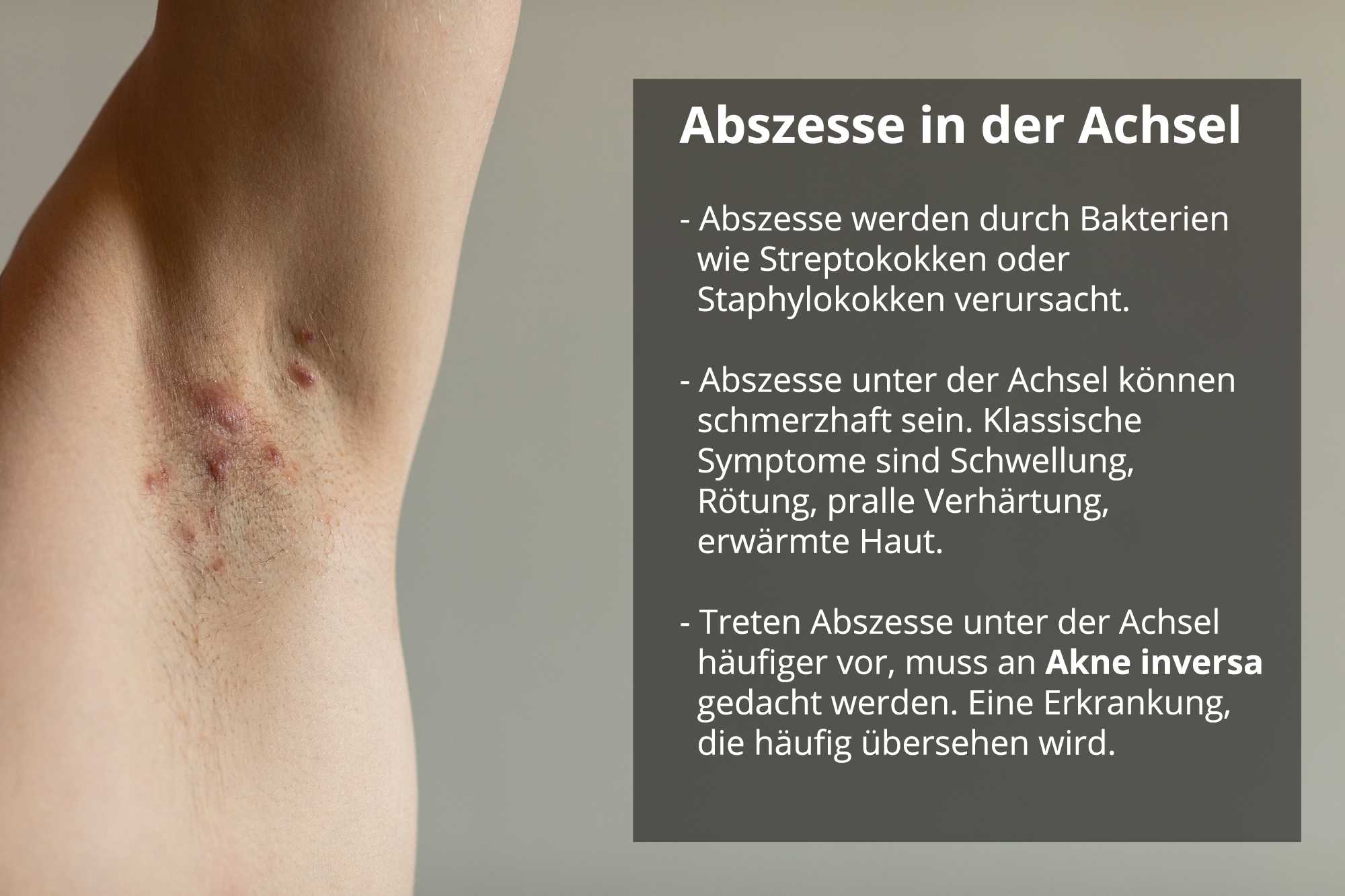 Abszess In Den Achseln Wie Erkennt Und Behandelt Man Ihn Abszess In Den Achseln Wie Erkennt Und Behandelt Man Ihn
