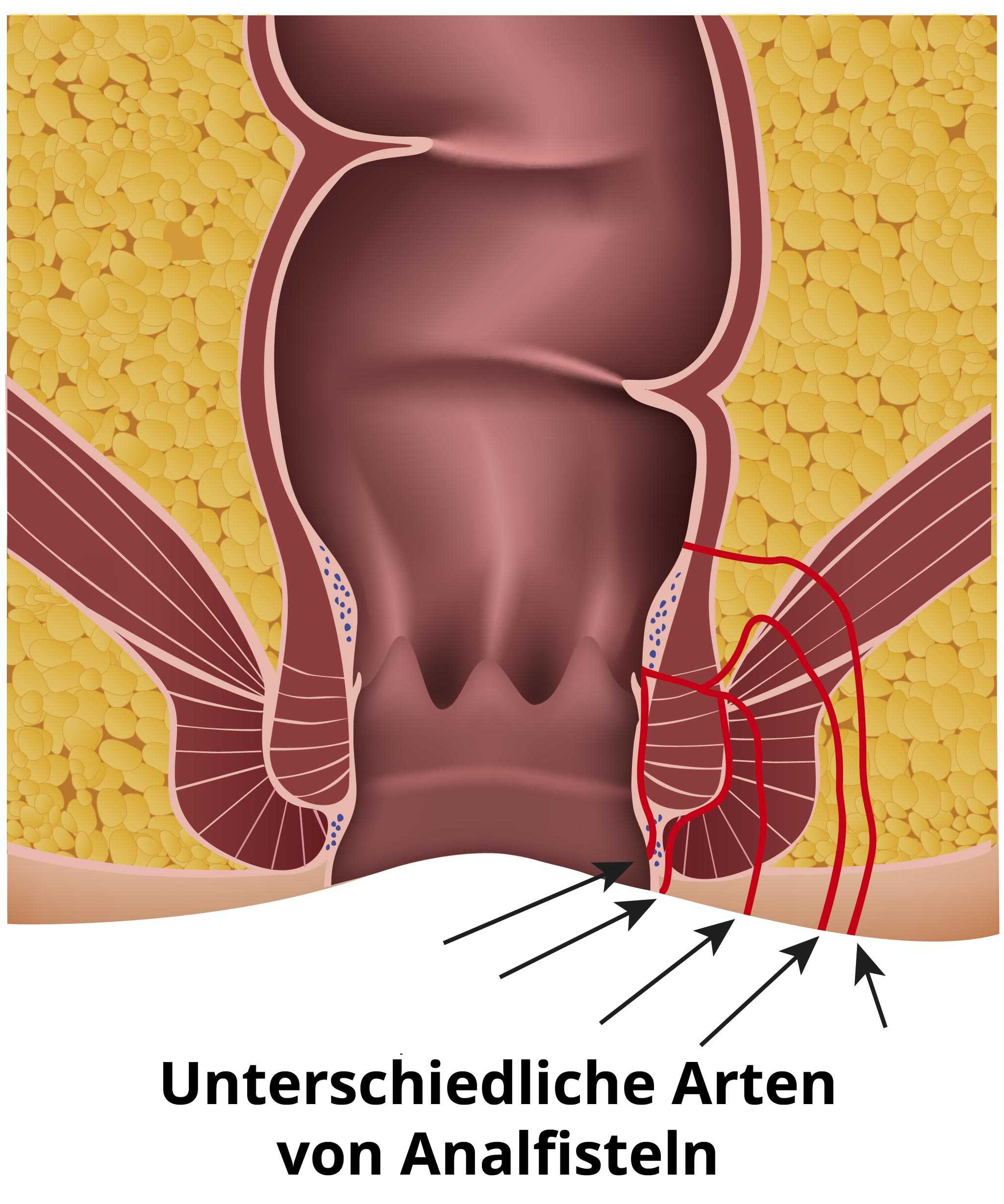 eiter in der nahe des anus