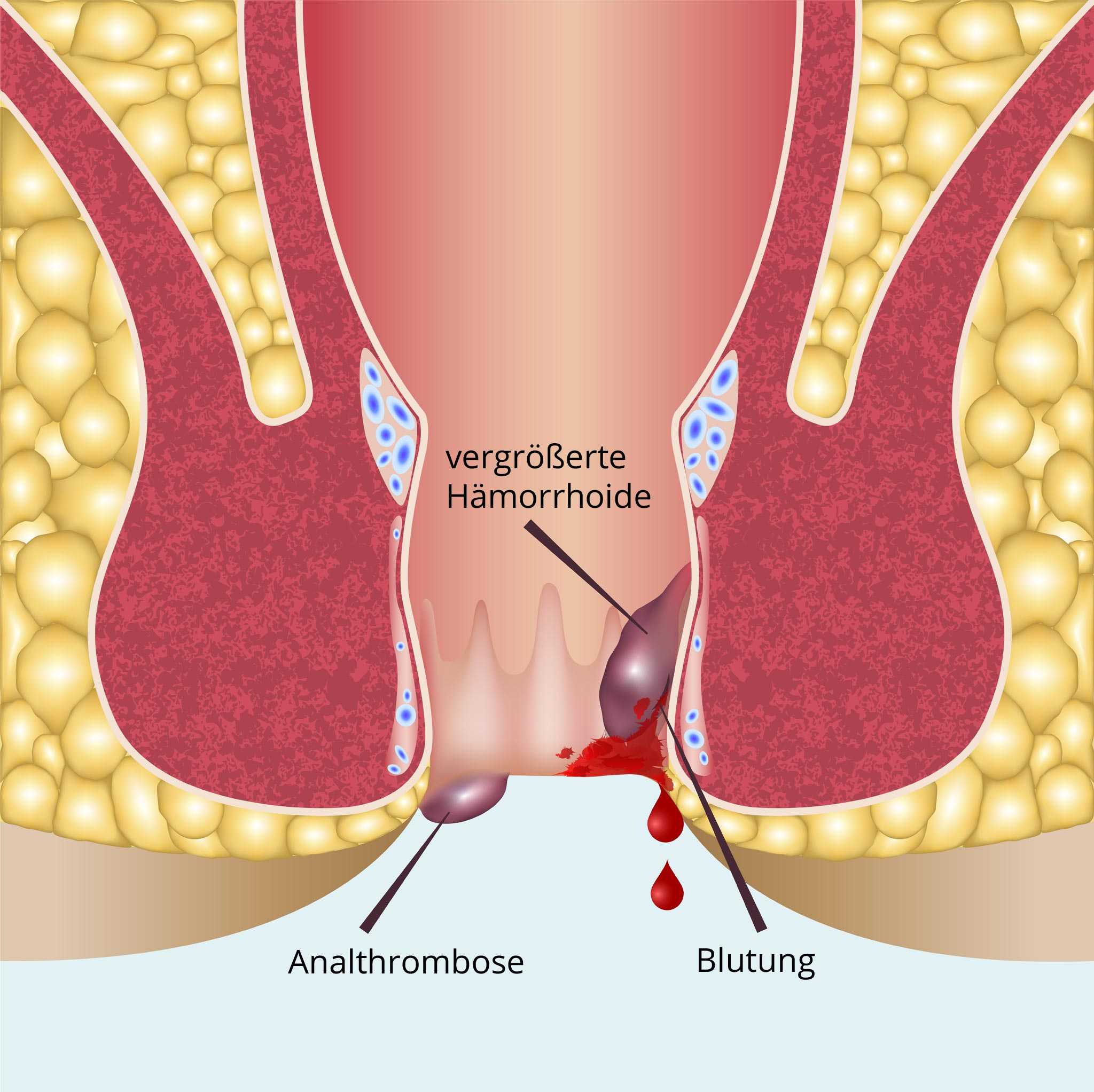 Anal thrombose External Thrombosed