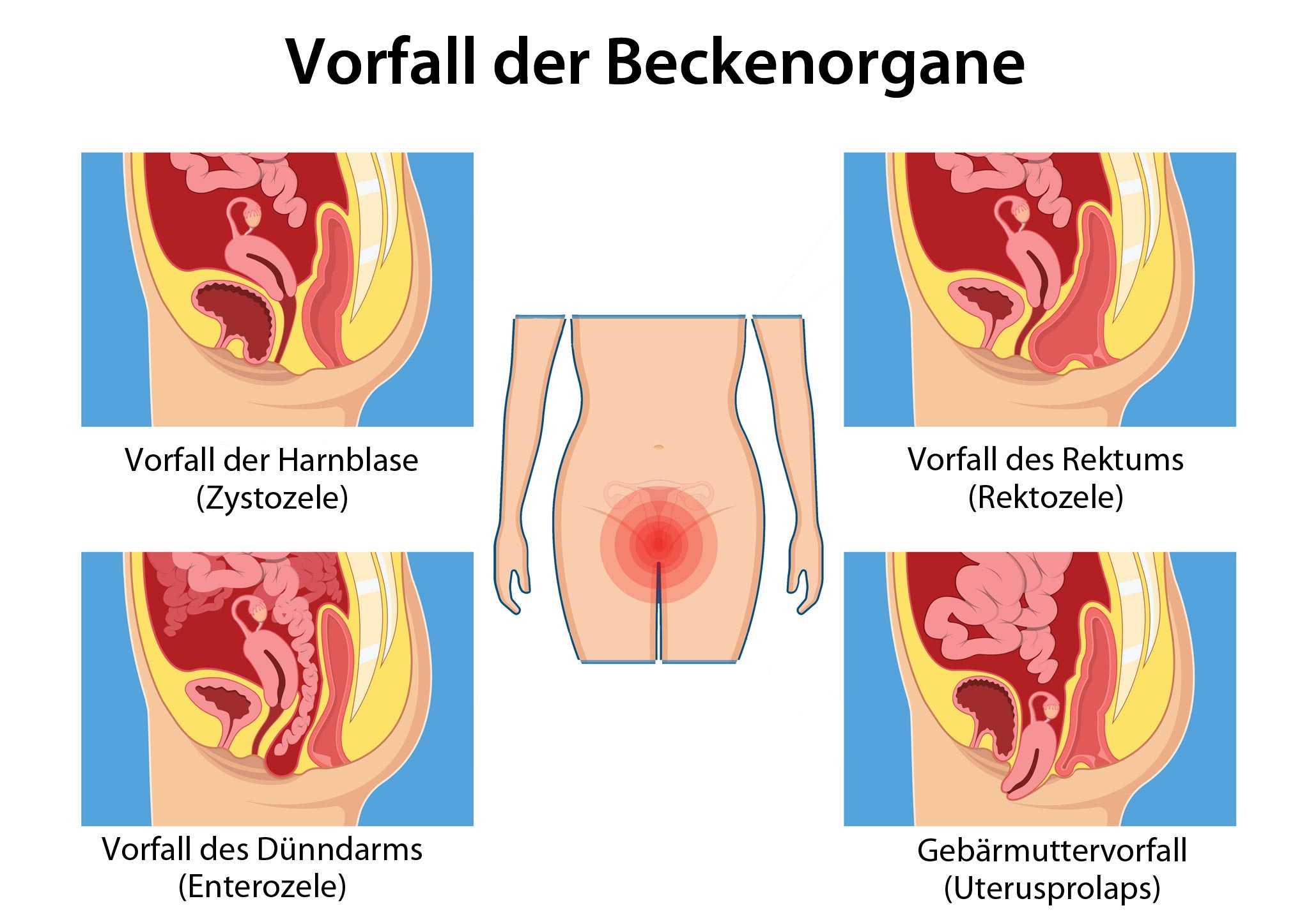 Gebärmutterentfernung stuhlgang nach Blasensenkukng, Darmsenkung