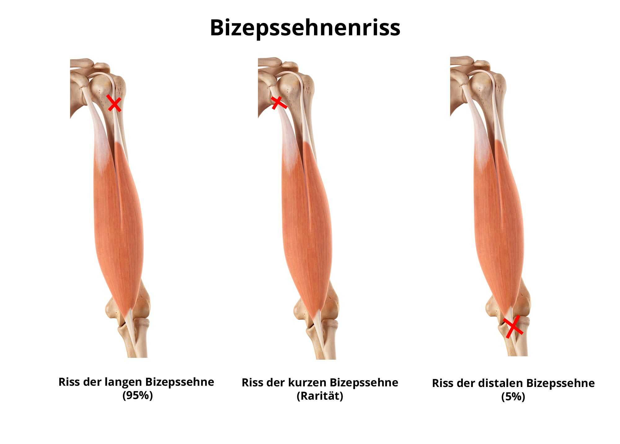 Entzündung bizepssehne