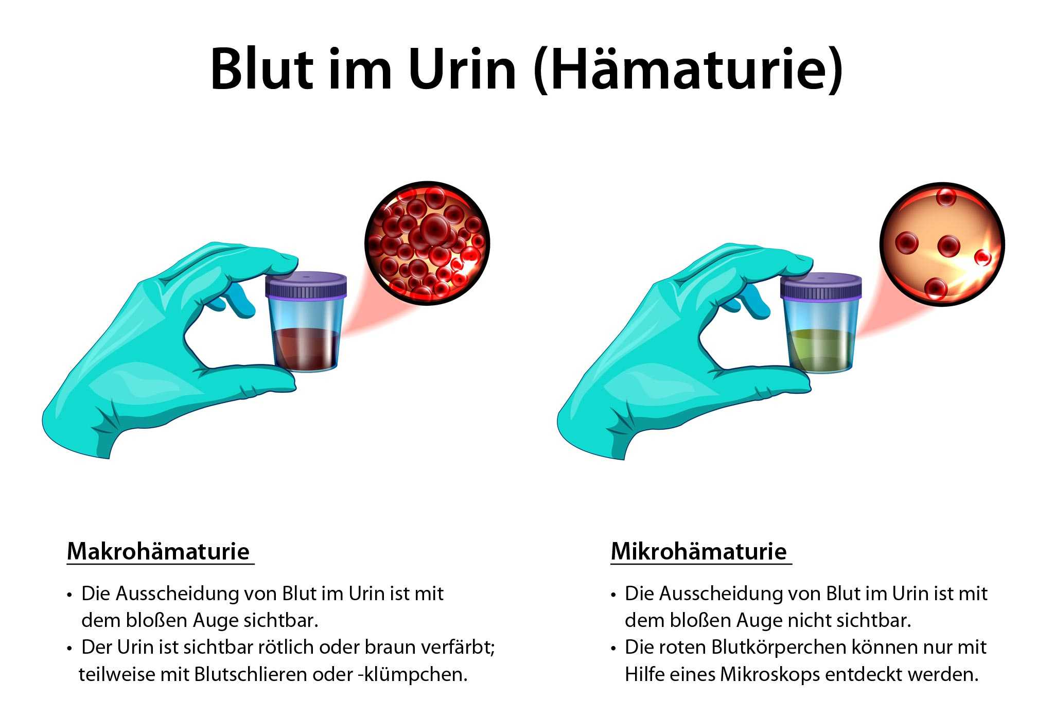 Blut im Urin " Ursachen, Symptome und Behandlung.