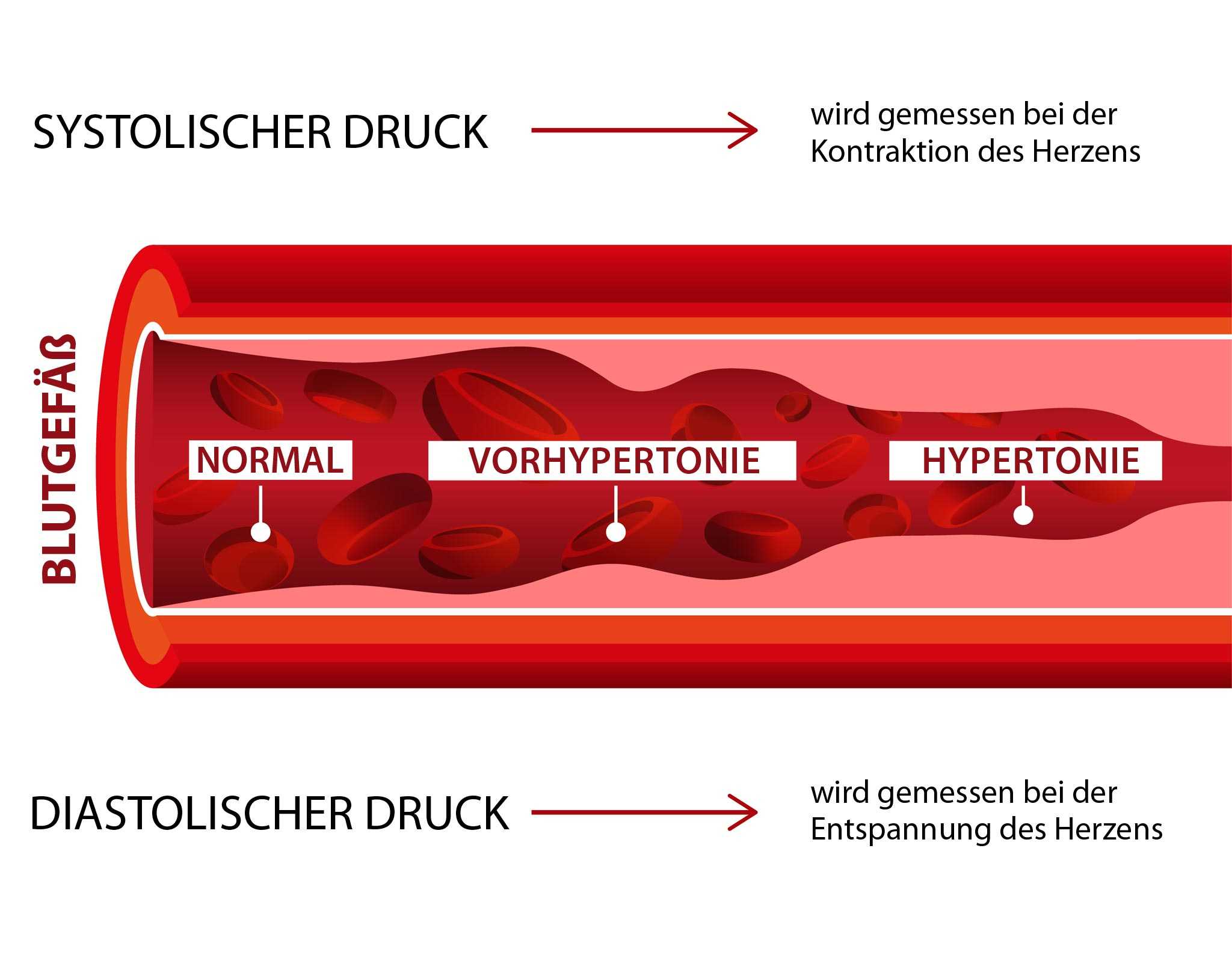 Welche Rolle spielen Blutdruck und Puls beim Herzinfarkt?