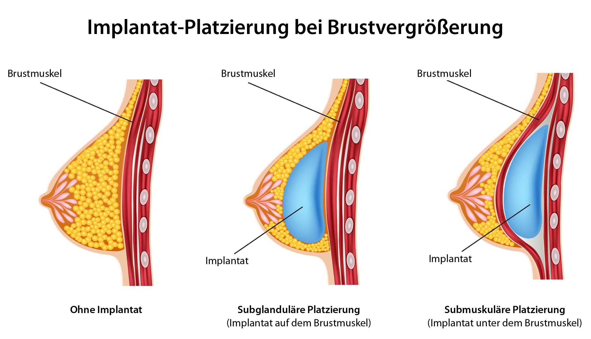 C brustvergrößerung Example C++