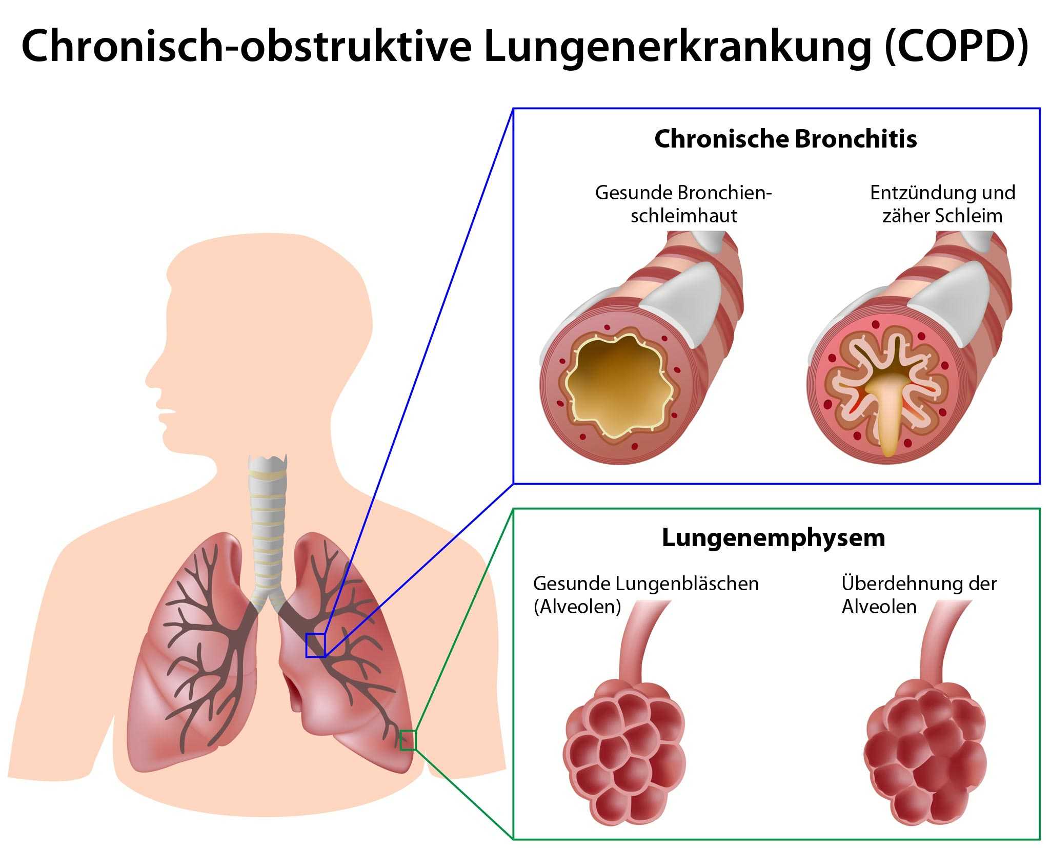 Chronische Bronchitis