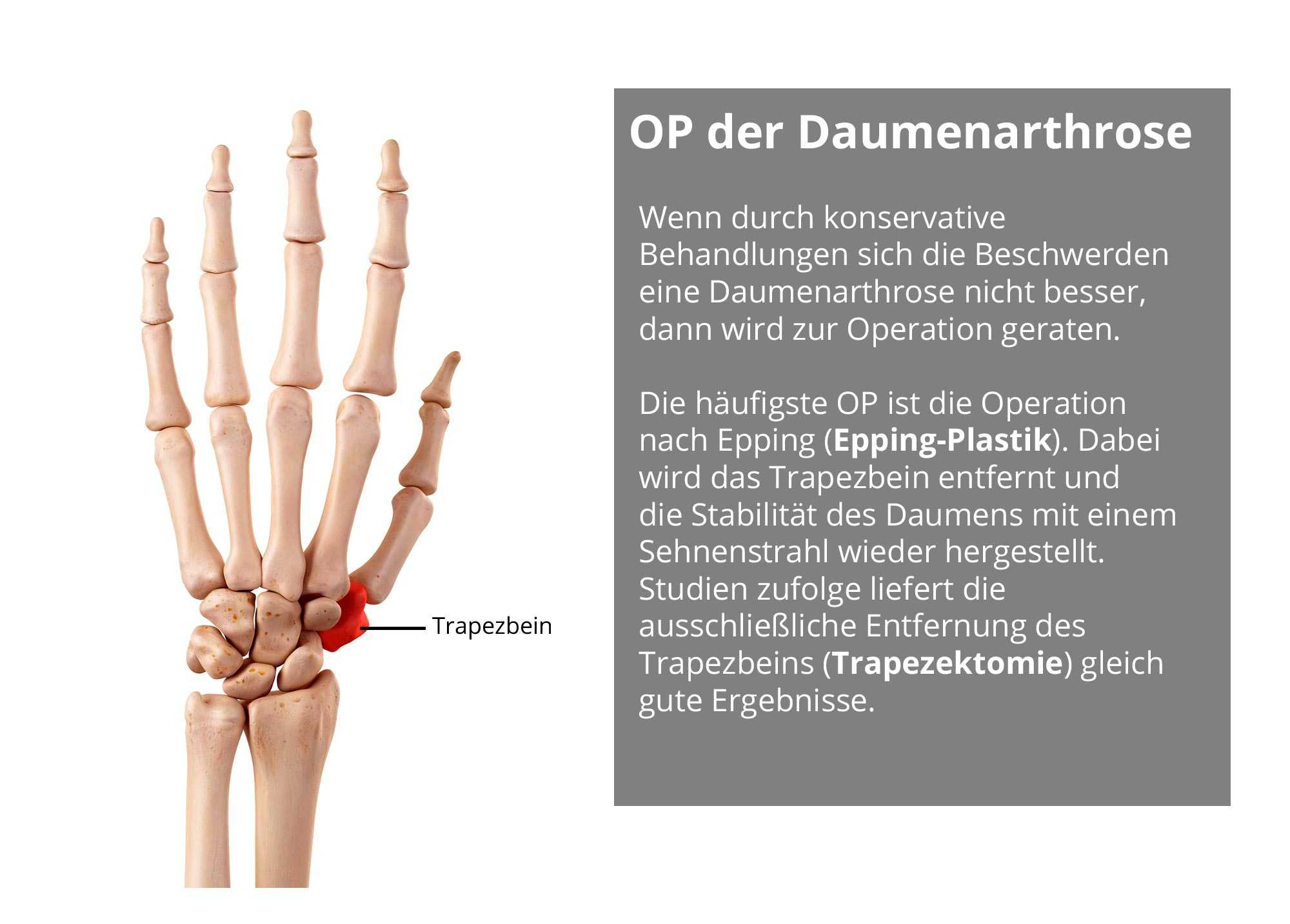 op-der-daumenarthrose-wie-lange-wird-man-krankgeschrieben