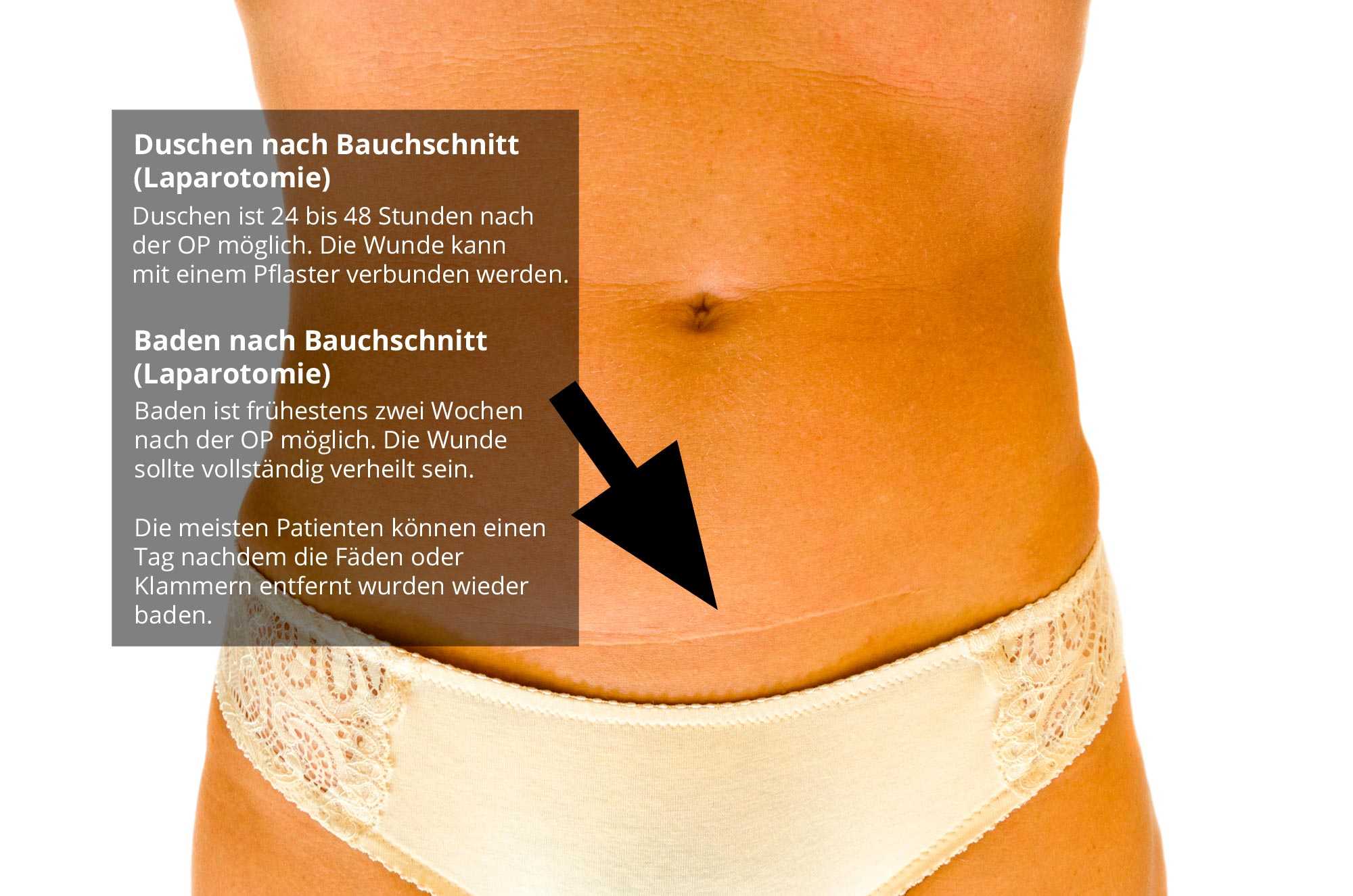 Am bauch narbe knubbel unter