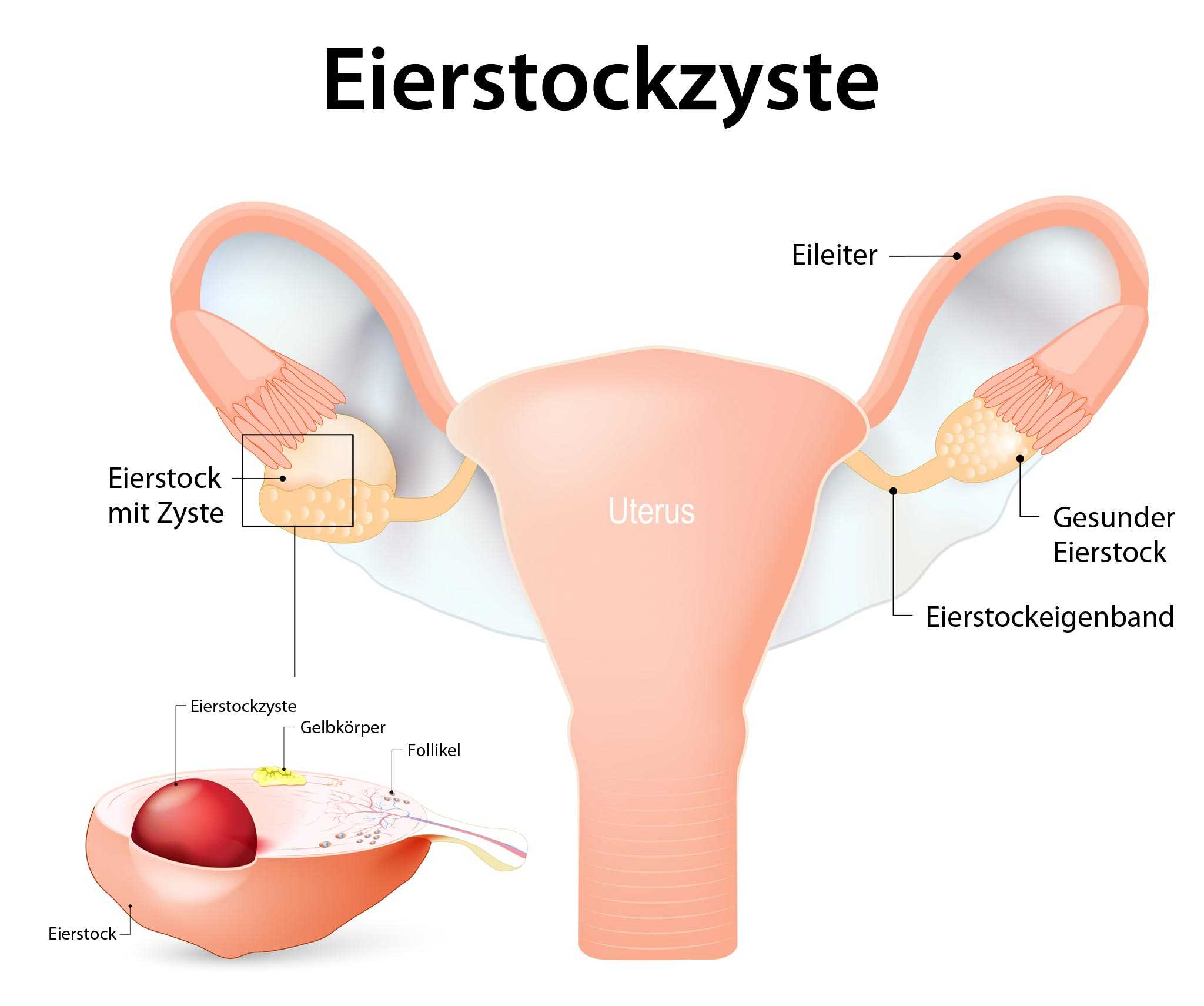 Entfernt ein eierstock Nur ein