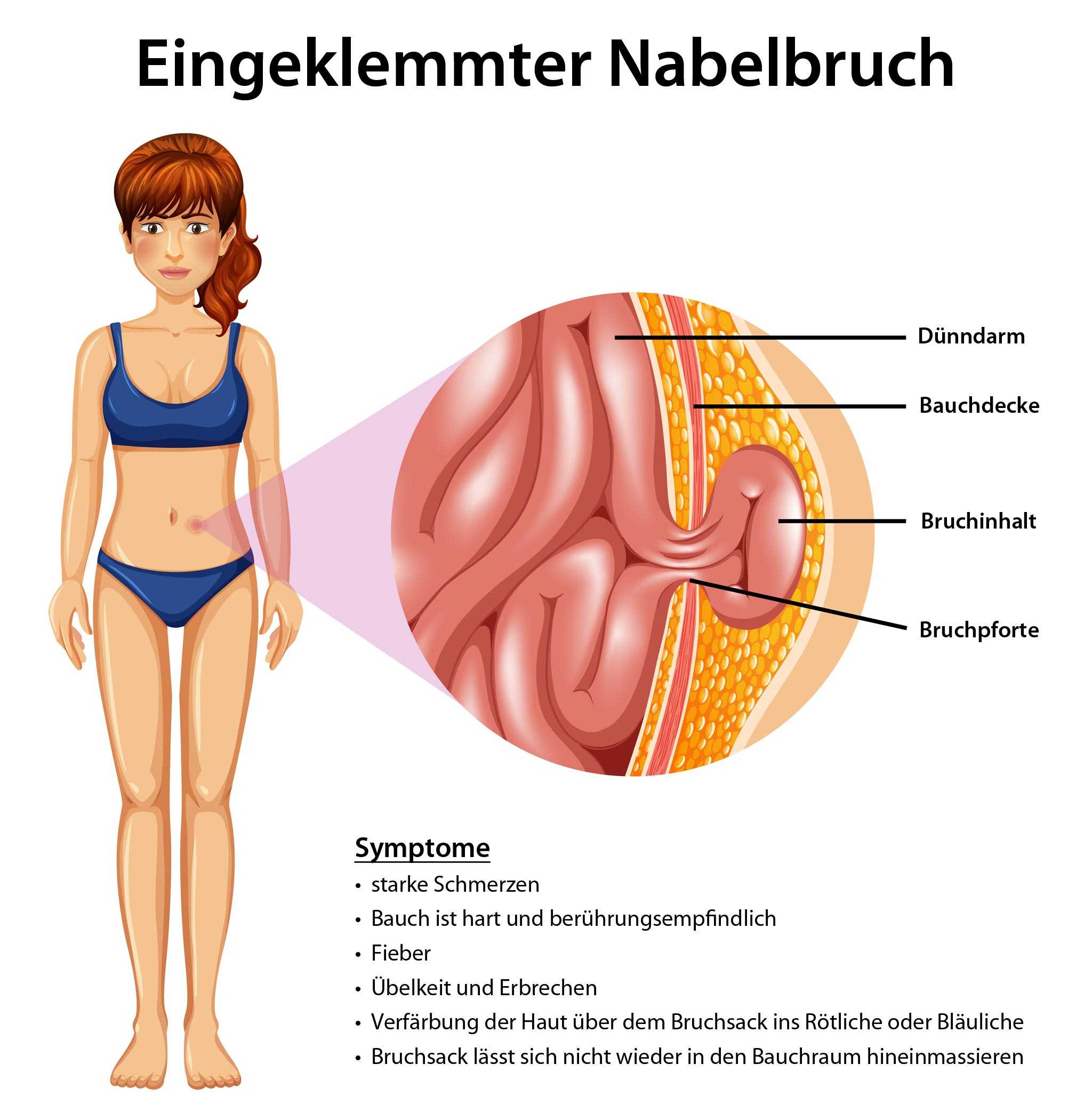 Wie äußert sich ein eingeklemmter Nabelbruch? 