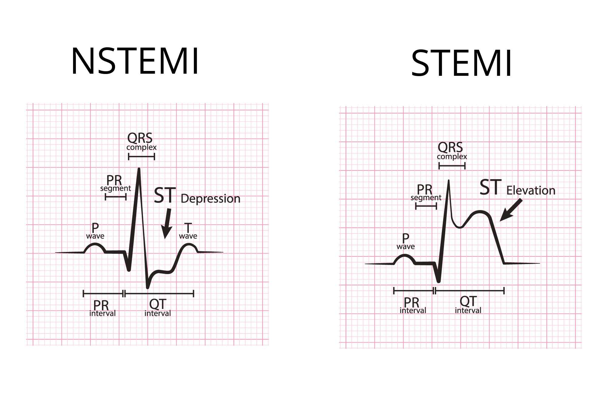 Detail contoh gambar ekg stemi koleksi nomer 34 vrogue co