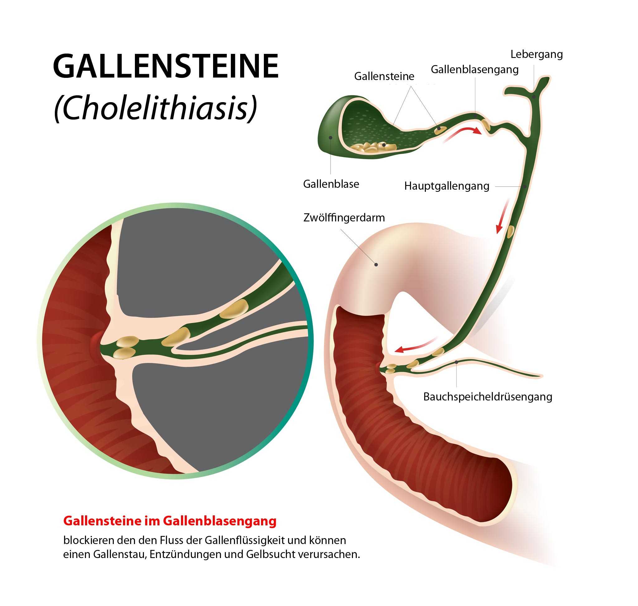 Gallenbeschwerden bauchschmerzen Gallenkolik