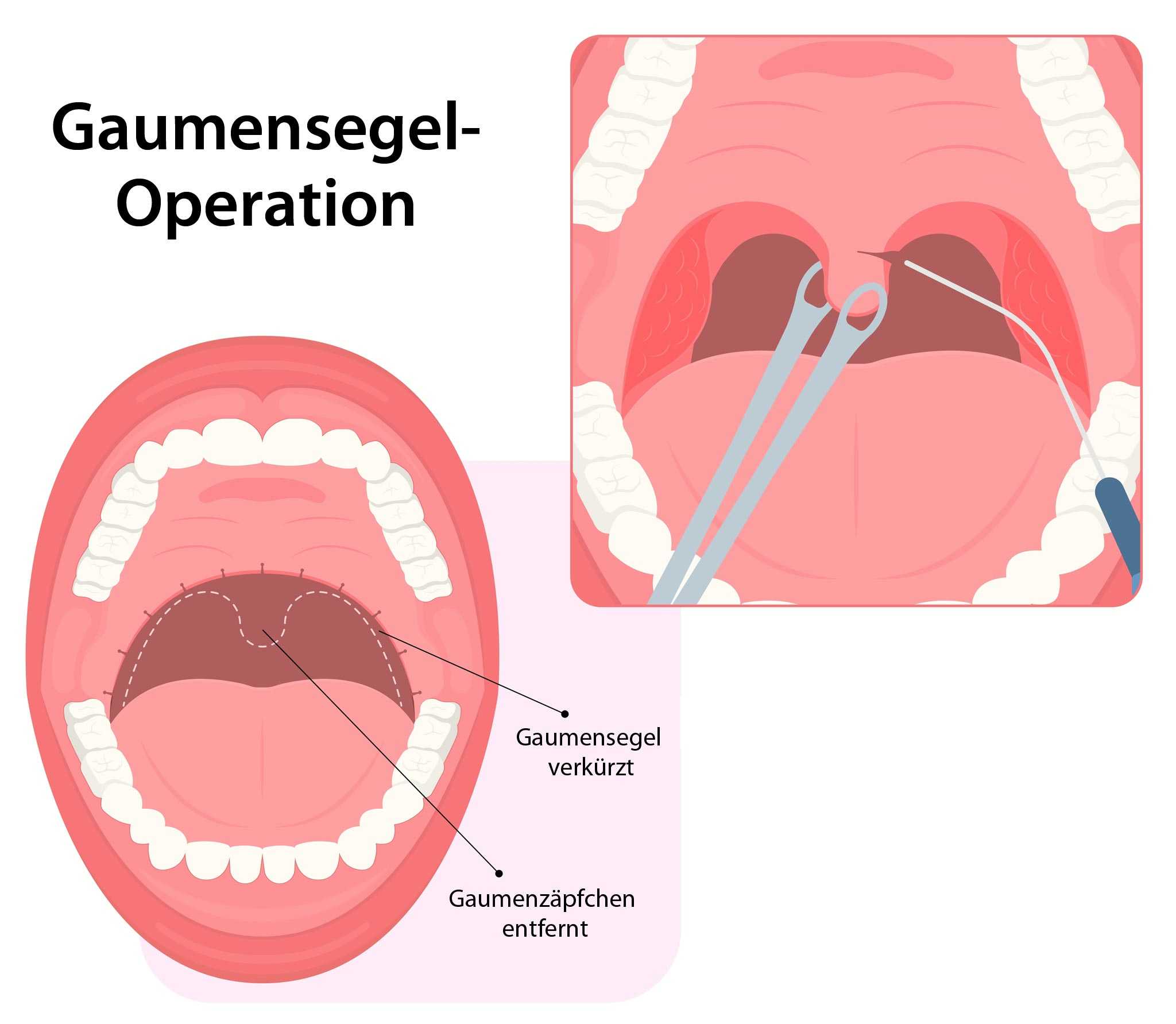 Gaumensegeloperation Schnarchen Schnarch Operation