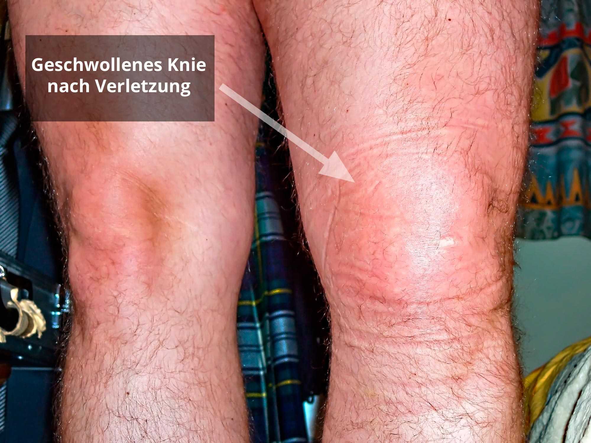 Knie fäden ziehen Arthroskopie Knie: