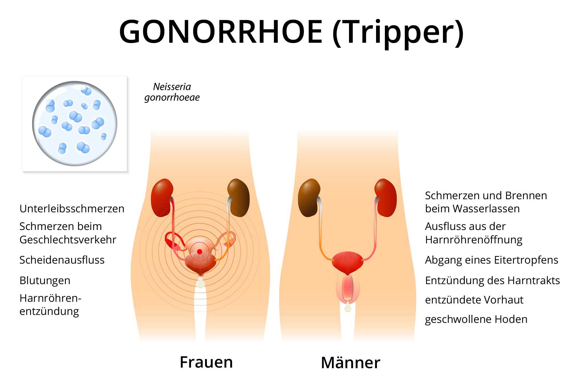 Mann ausfluss Erektionsprobleme Was