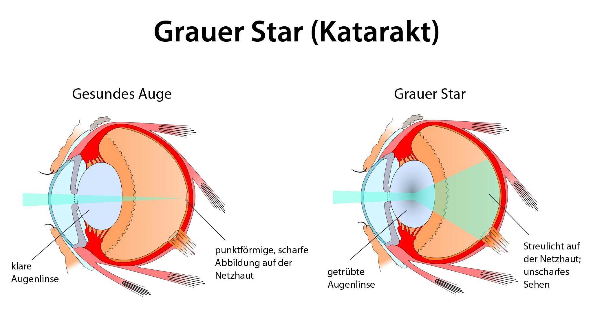Was Ist Der Graue Star Was Ist Der Graue Star