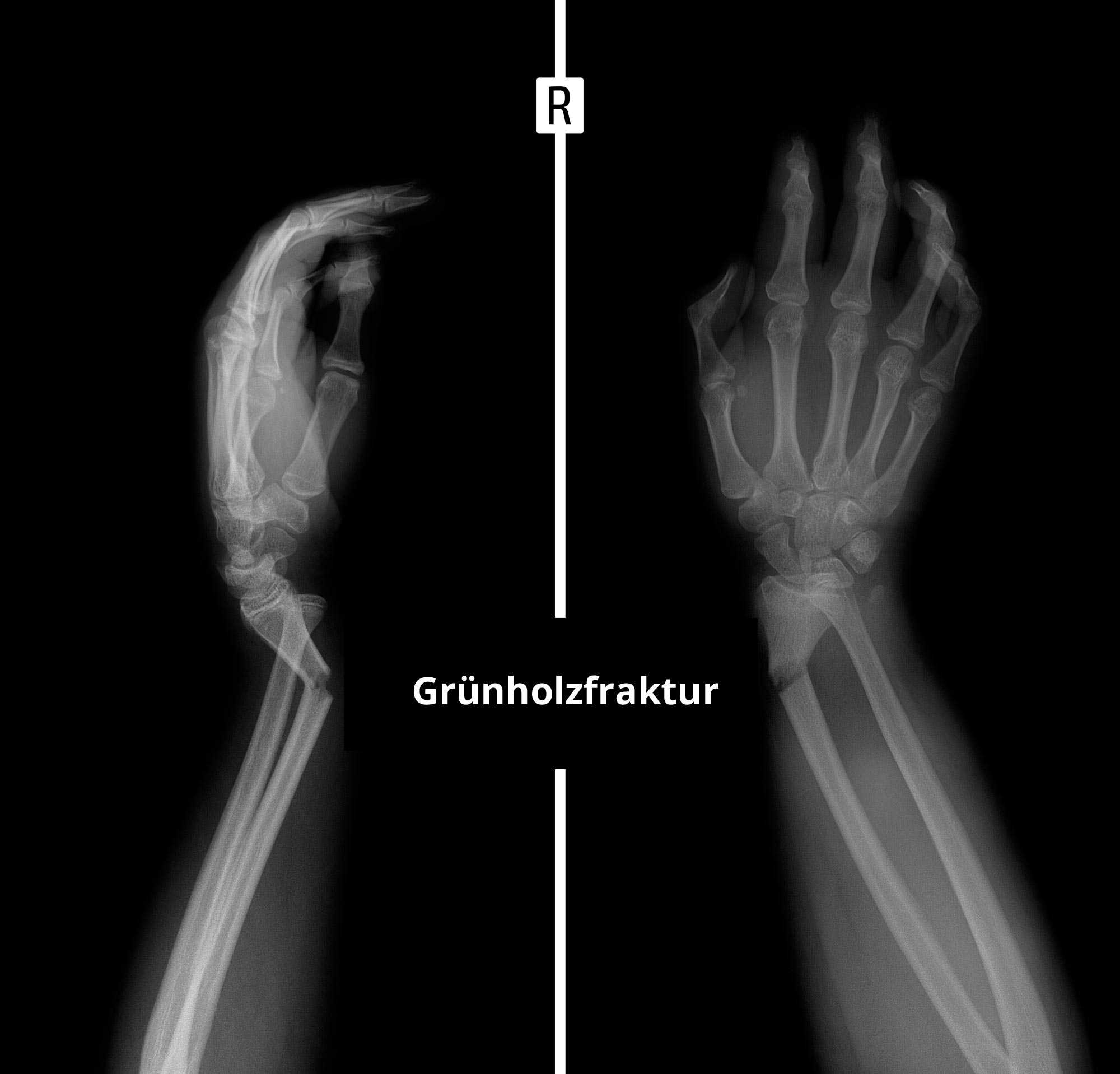 Schmerzen handgelenk brechen ohne Schmerzen im