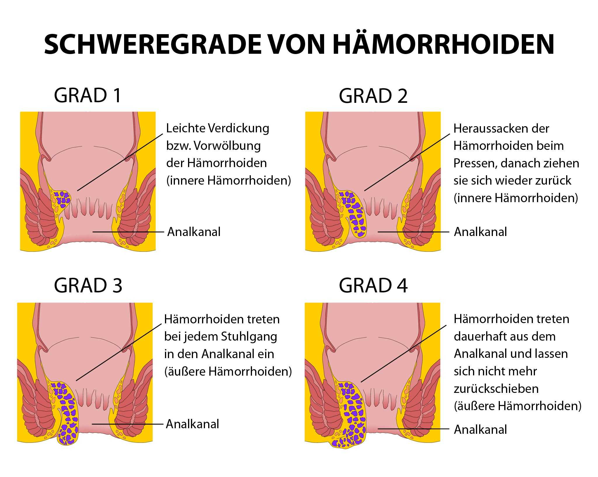 Bluten marisken Harmlose Analknubbel: