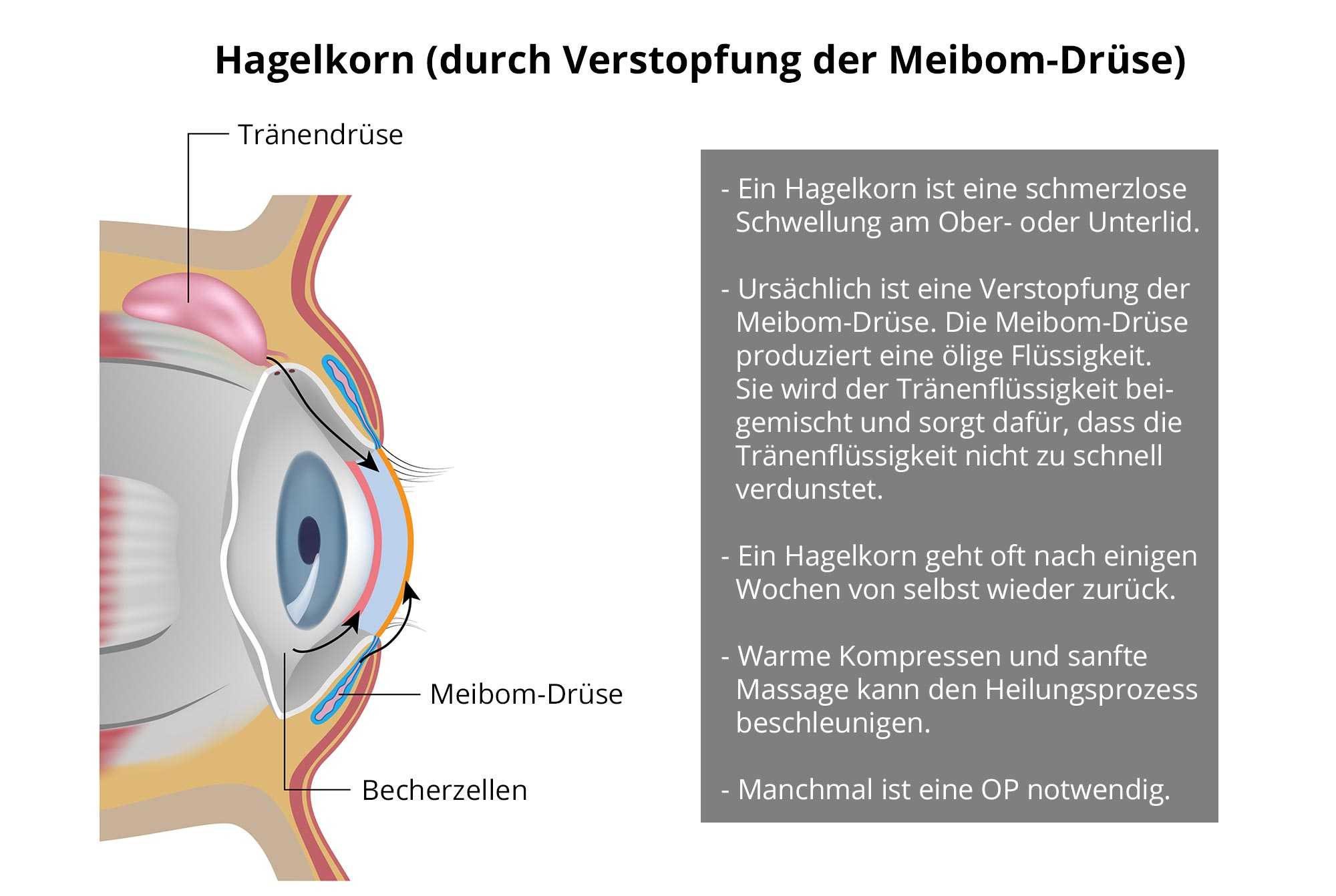 Auge beule im Verklebte Augen: