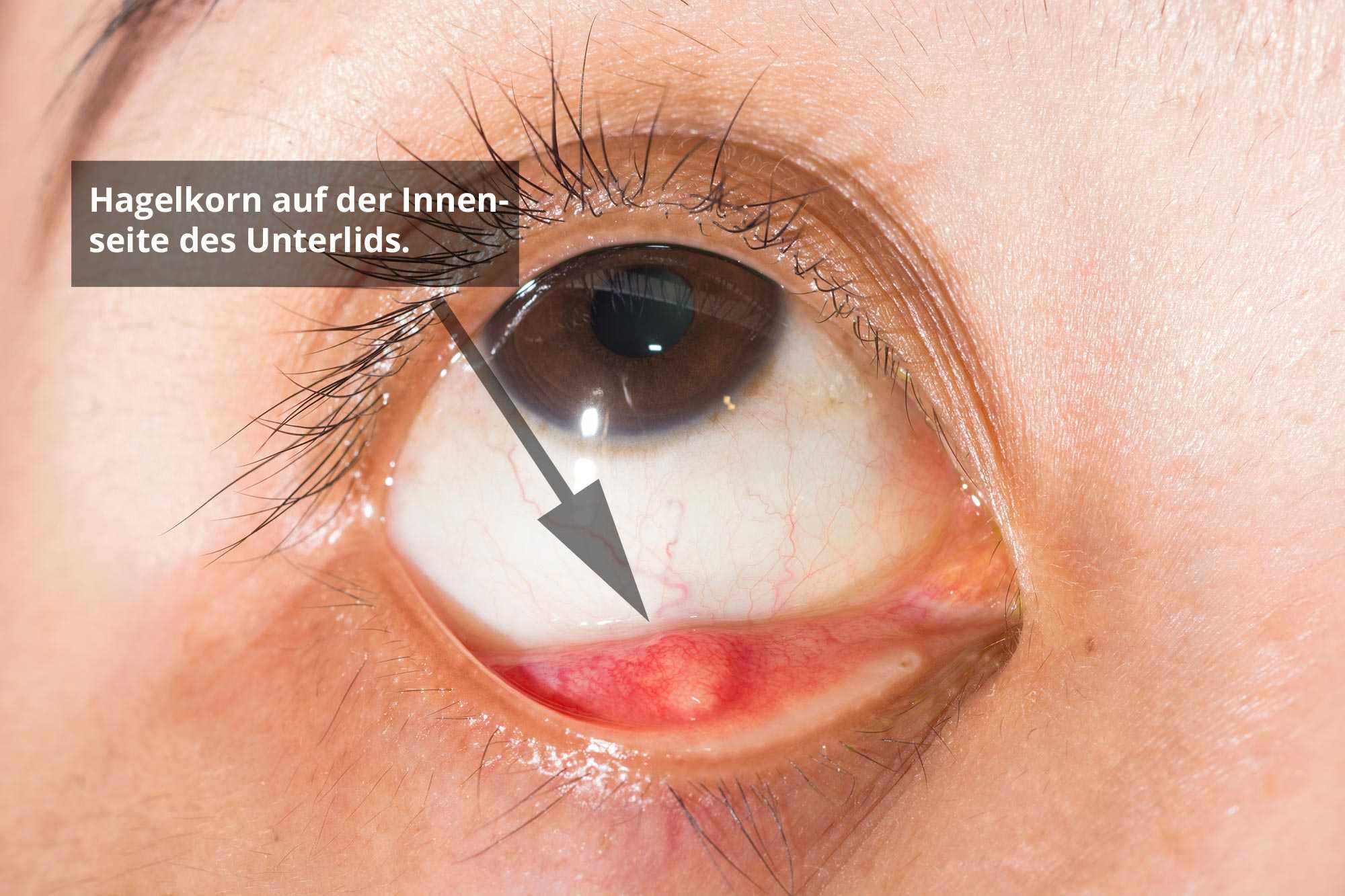 Auge beule im Augenprobleme homöopathisch
