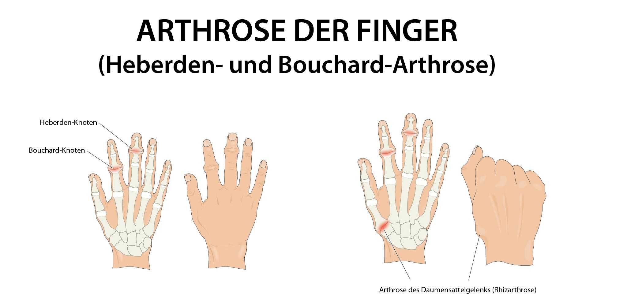 Knubbel finger Ganglion (Überbein):