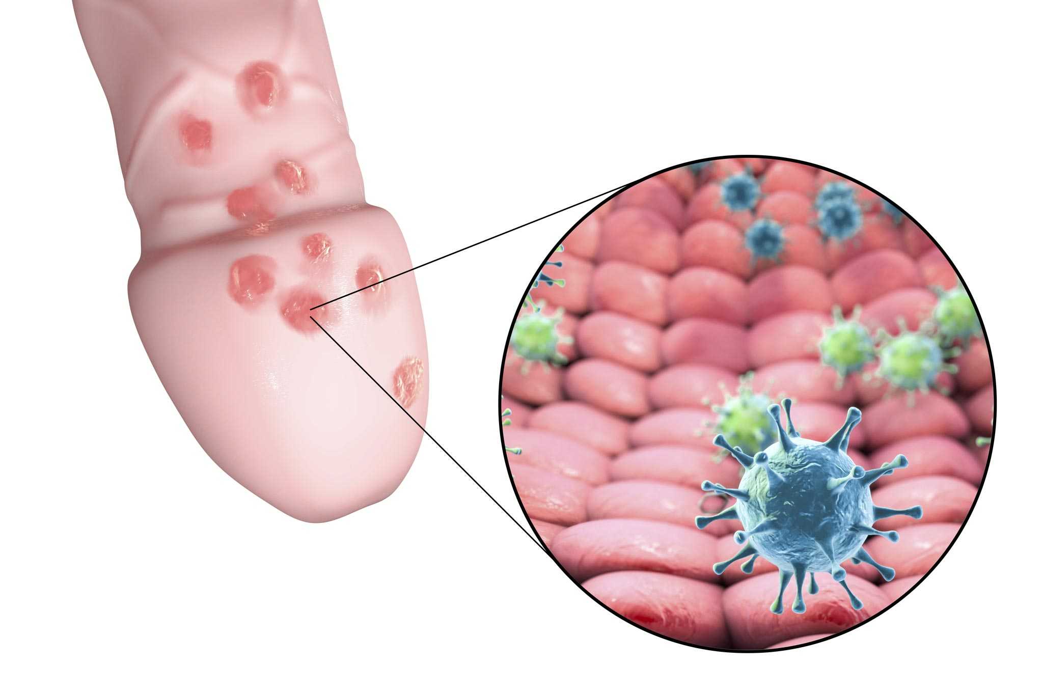 Herpes genitalis wird durch das Herpes-simplex-Virus 1 (HSV1) oder Herpes-s...