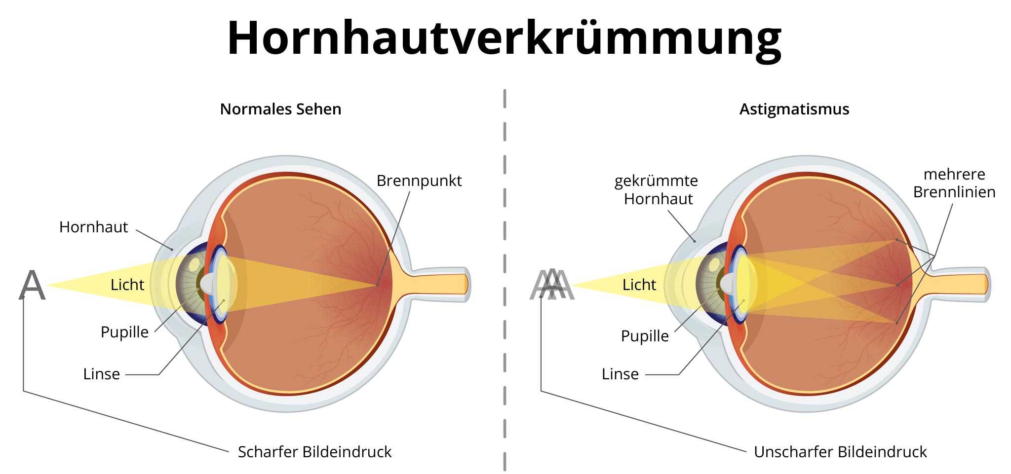 Hornhautverkr mmung Astigmatismus Ursachen Behandlung