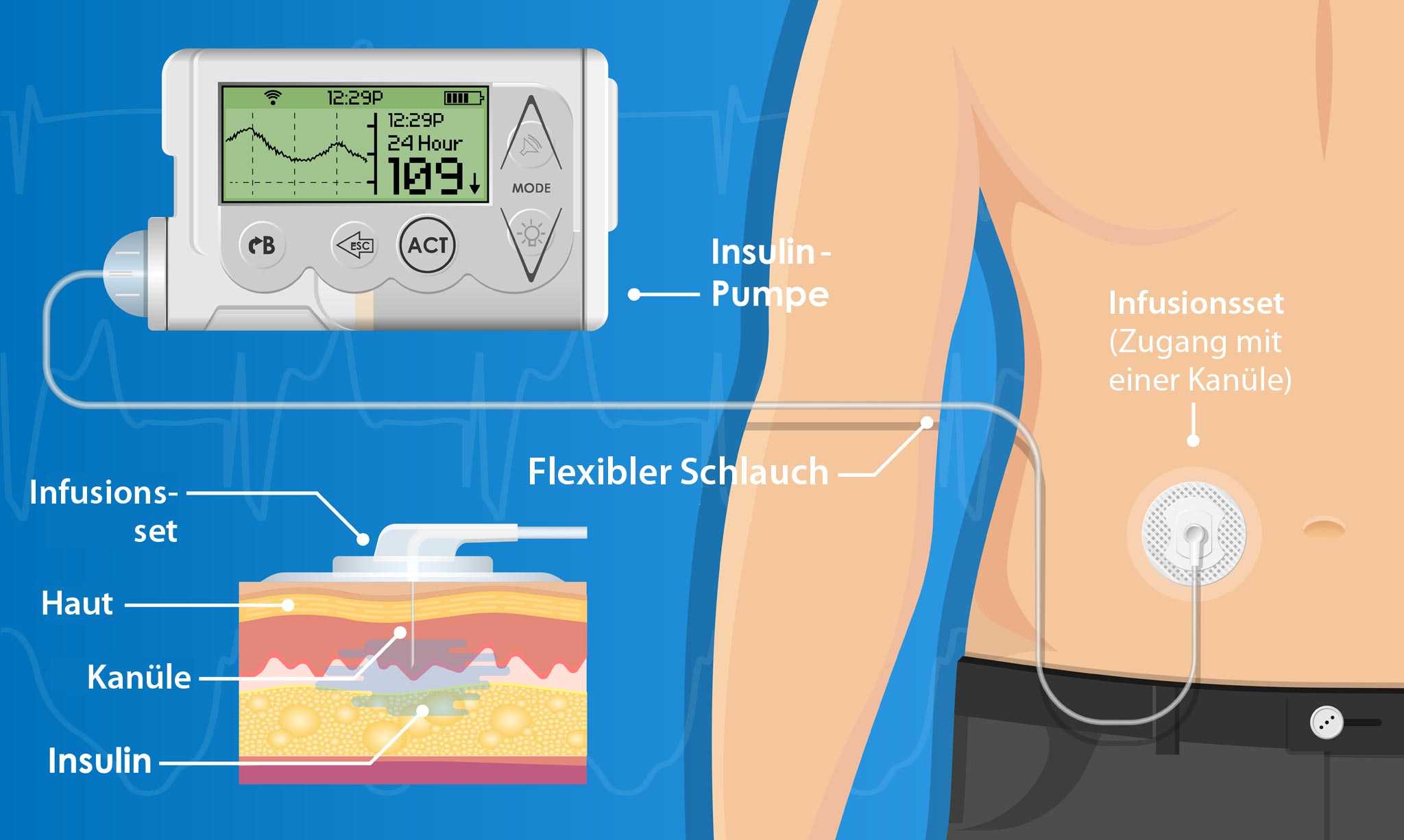 Sahne Schlauch wegschmeißen diabetes pumpe ohne schlauch Sagen Richtung