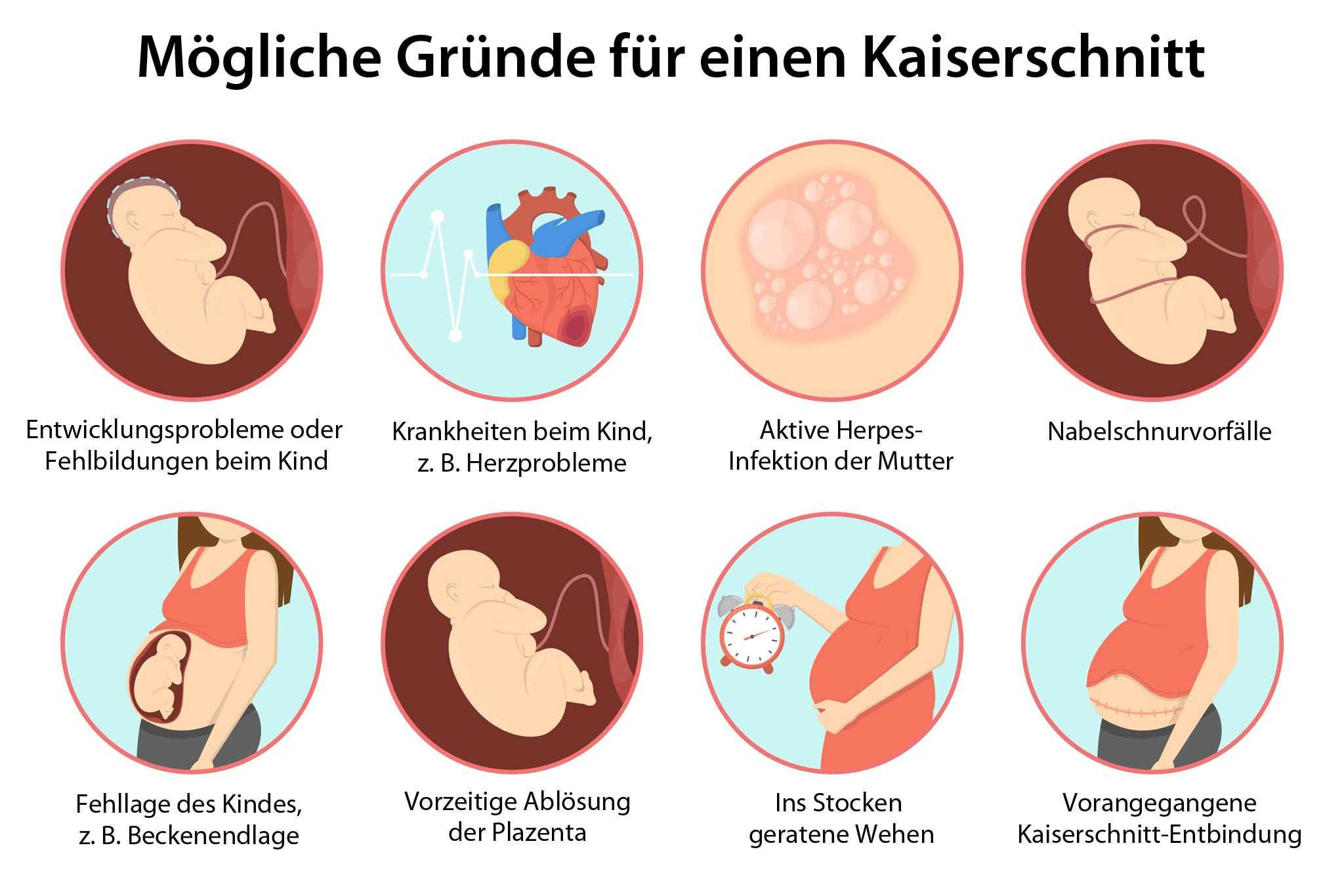 Kaiserschnitt Schnittentbindung Sectio caesarea Geburt