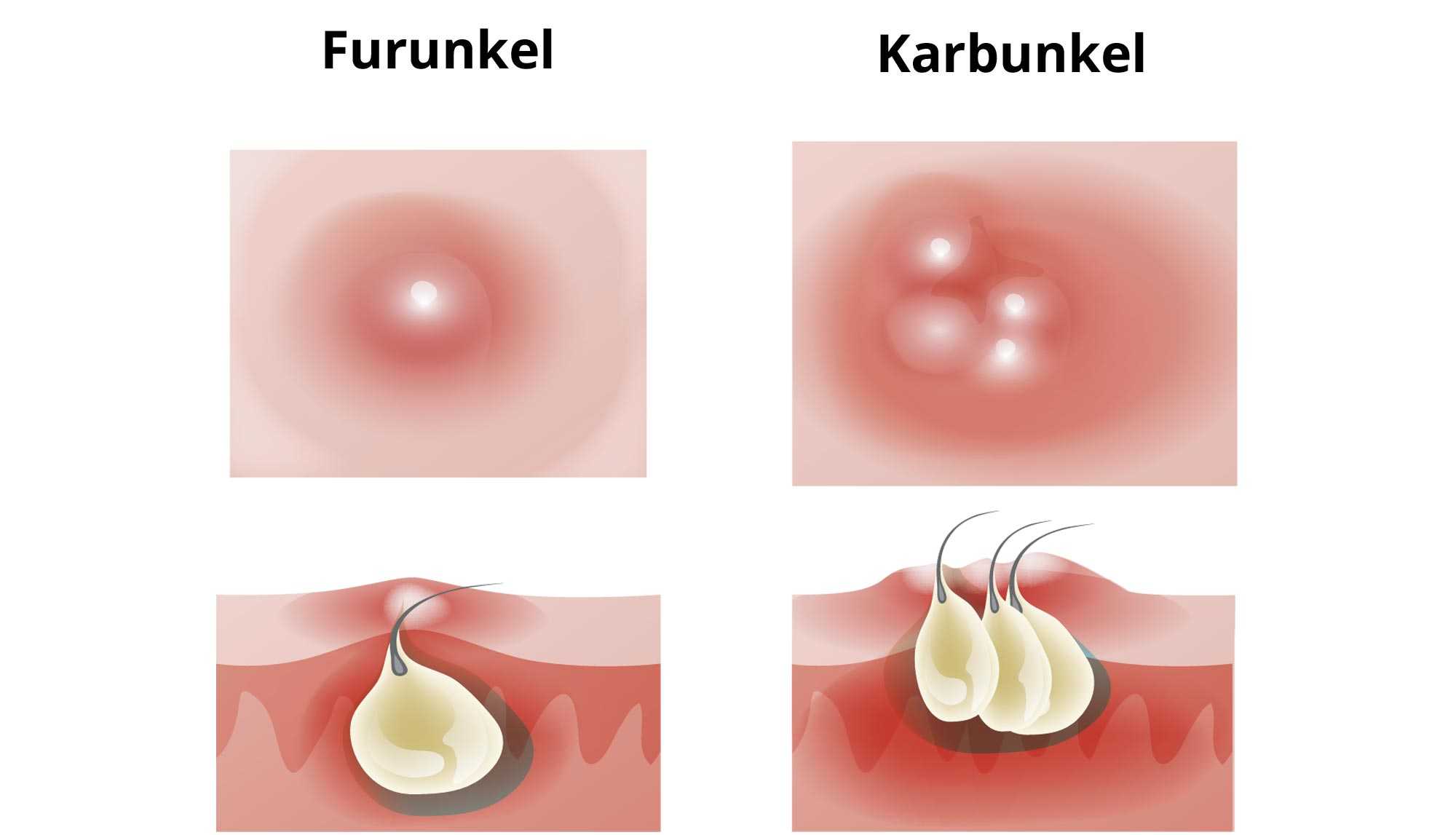 Furunkel öffnen