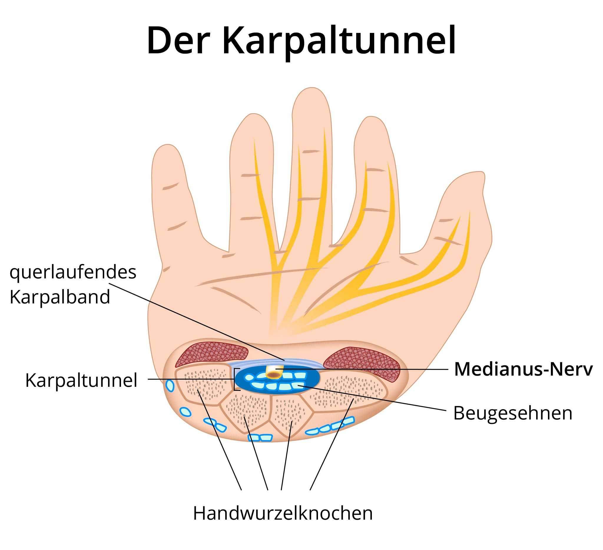 Erfahrungen karpaltunnelsyndrom op Operation des