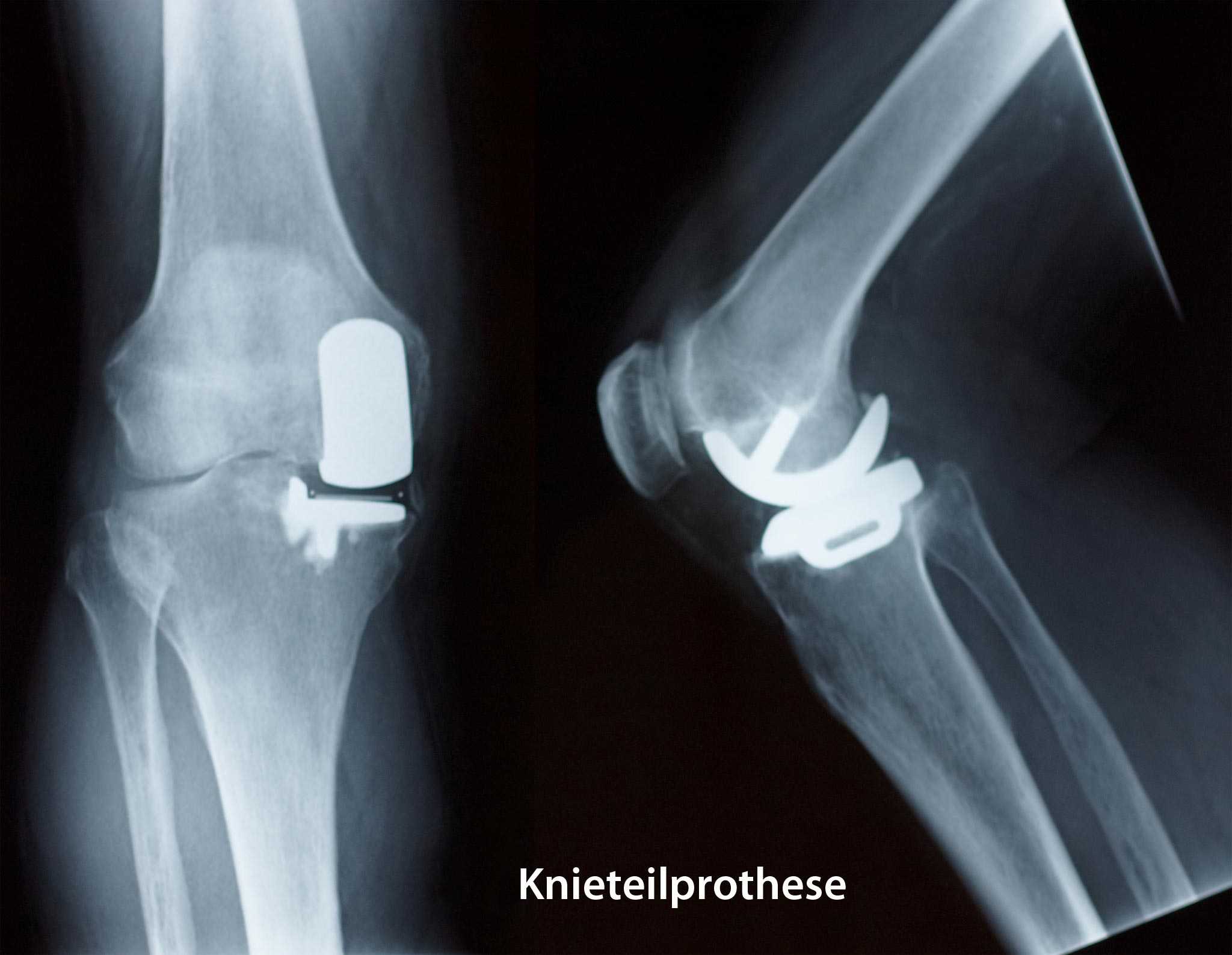 Kniegelenkersatz » was ist eine Schlittenprothese?