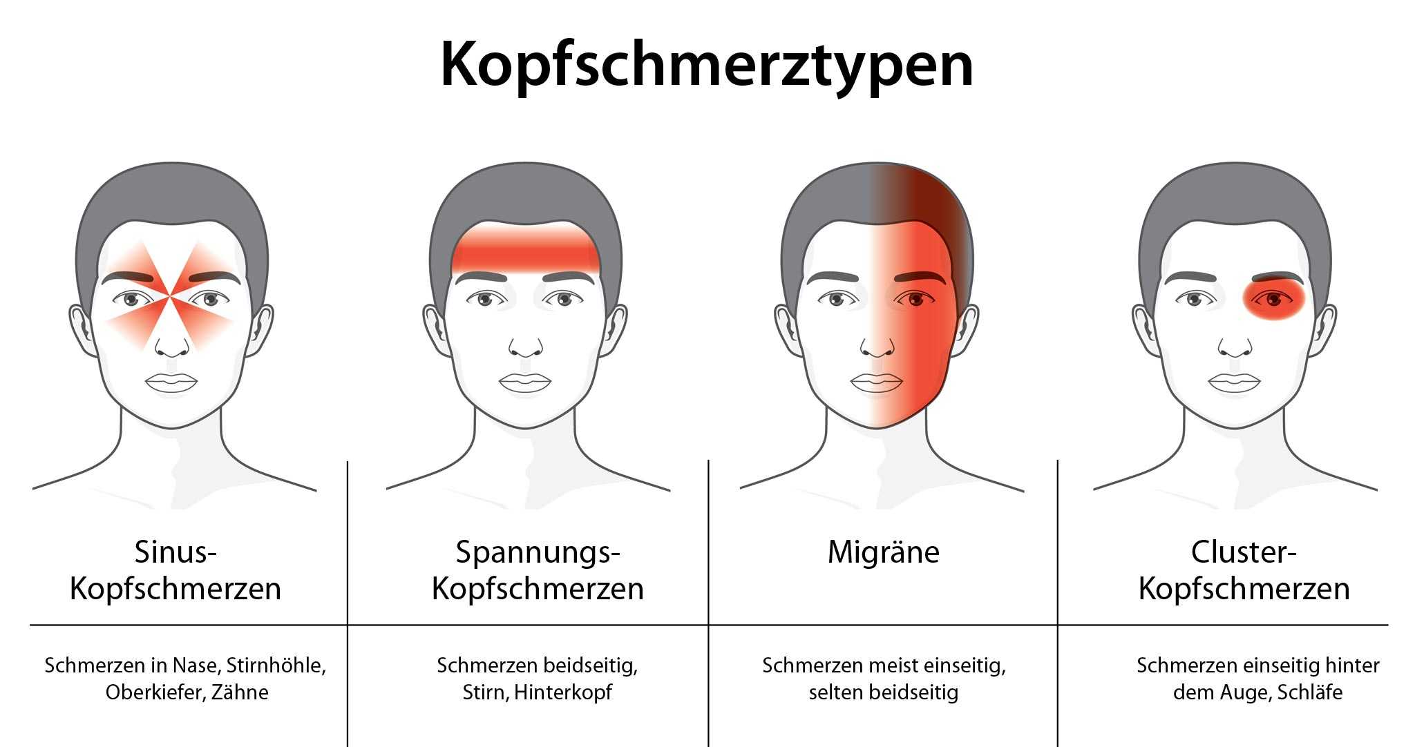 Welche Arten Von Kopfschmerzen Gibt Es