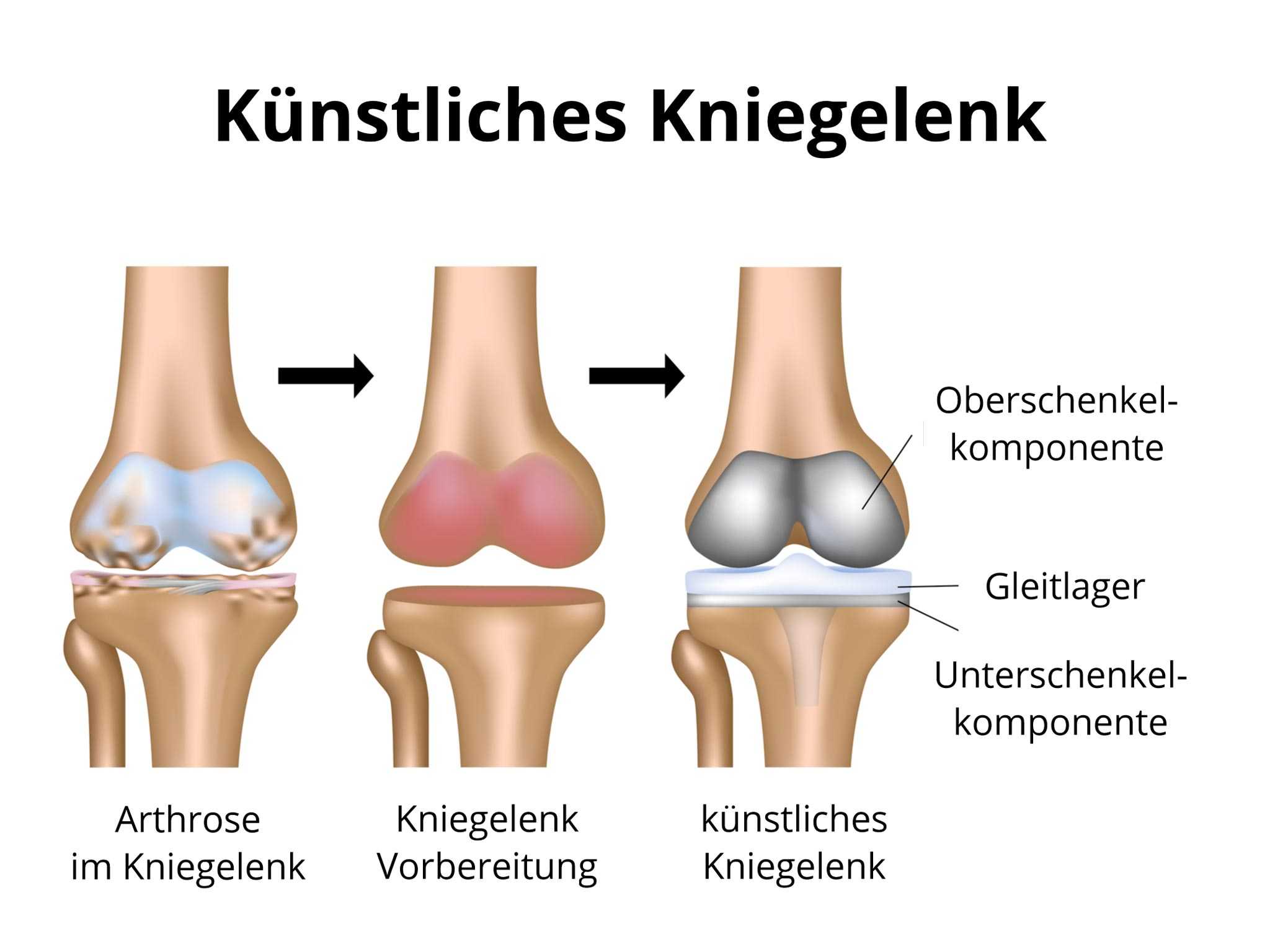Knie wie arbeitsunfähig künstliches lange OZF: Schlittenprothese