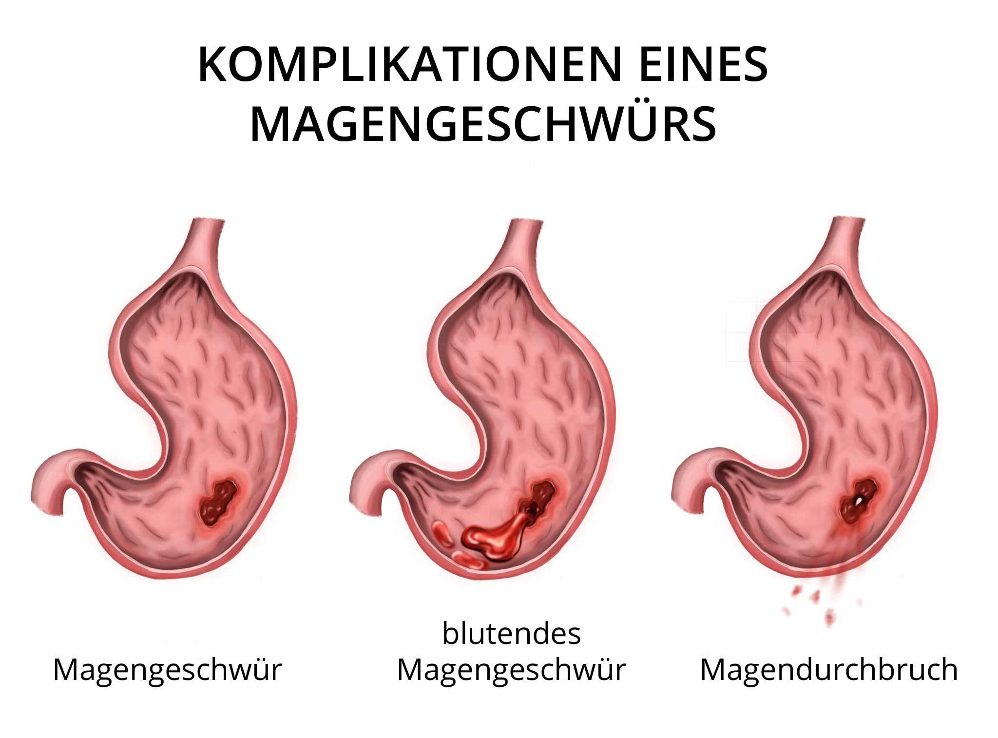 Anzeichen alkoholiker äußere Das Jellinek