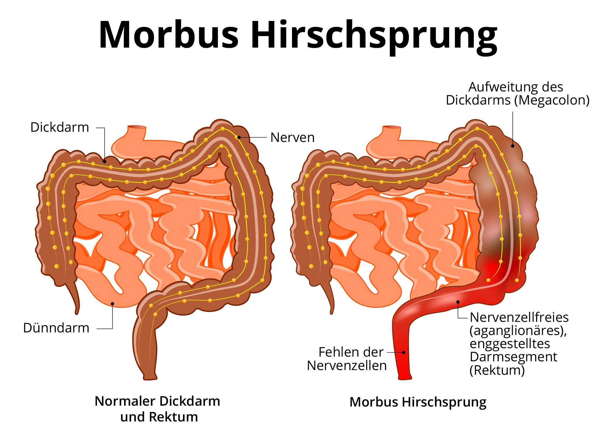 Trunk bibliotheek Botsing Beroemdheid Morbus Hirschsprung » Ursachen, Symptome, Therapie, Prognose