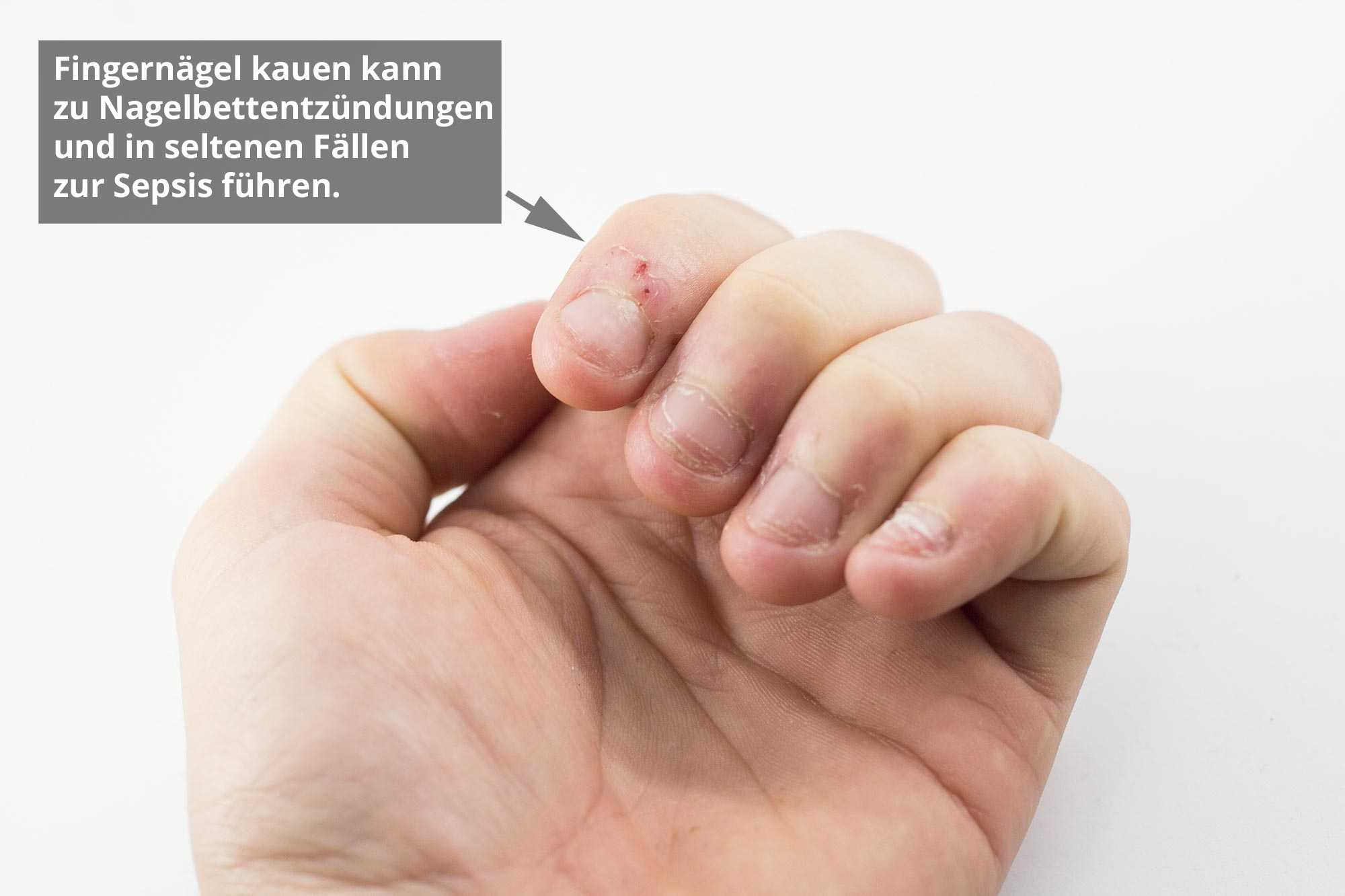 Gerissen nagelbett nagel aus Eingerissener Nagel