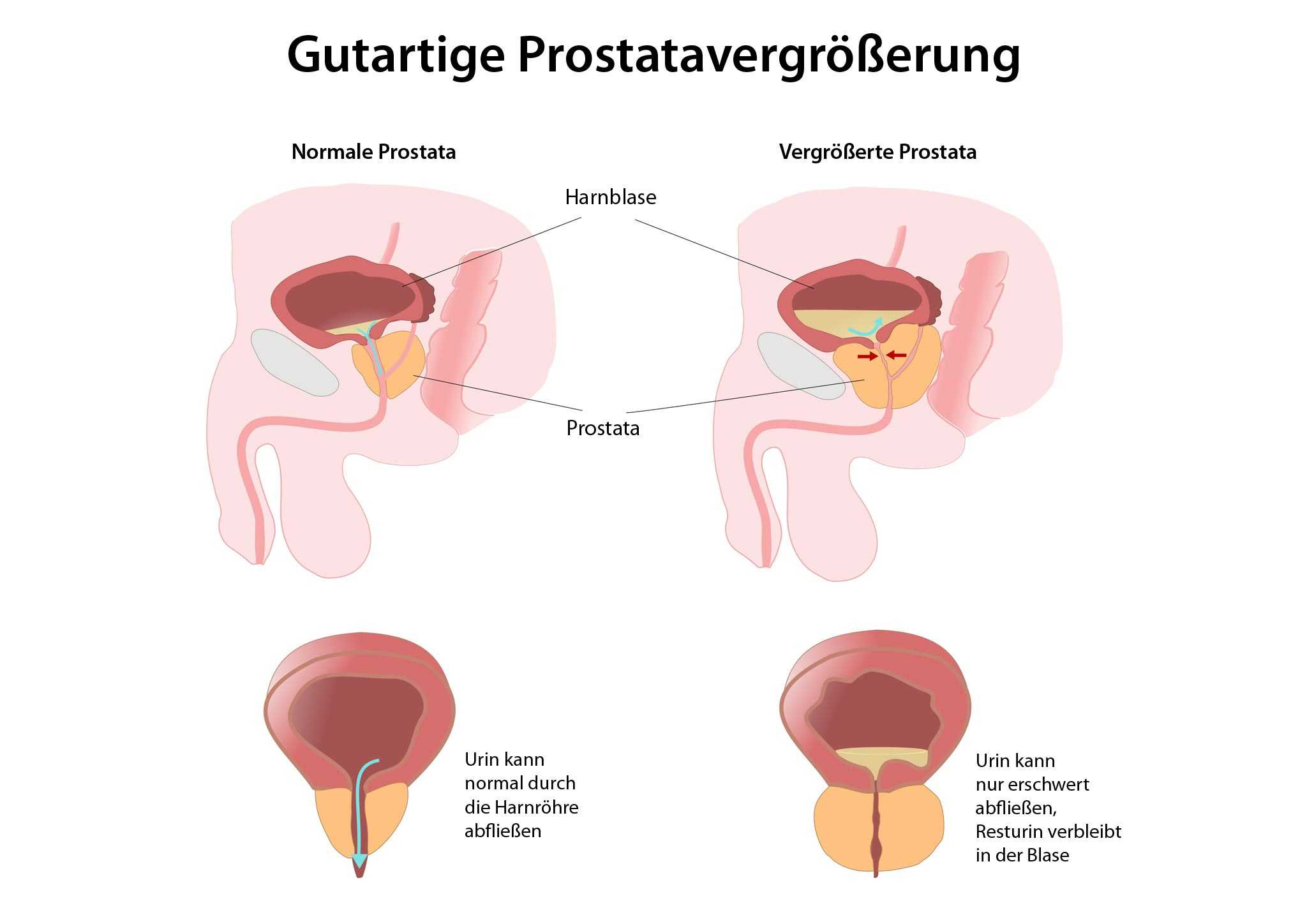 Gutartige Prostatavergrosserung Diagnose Op Ausschalung