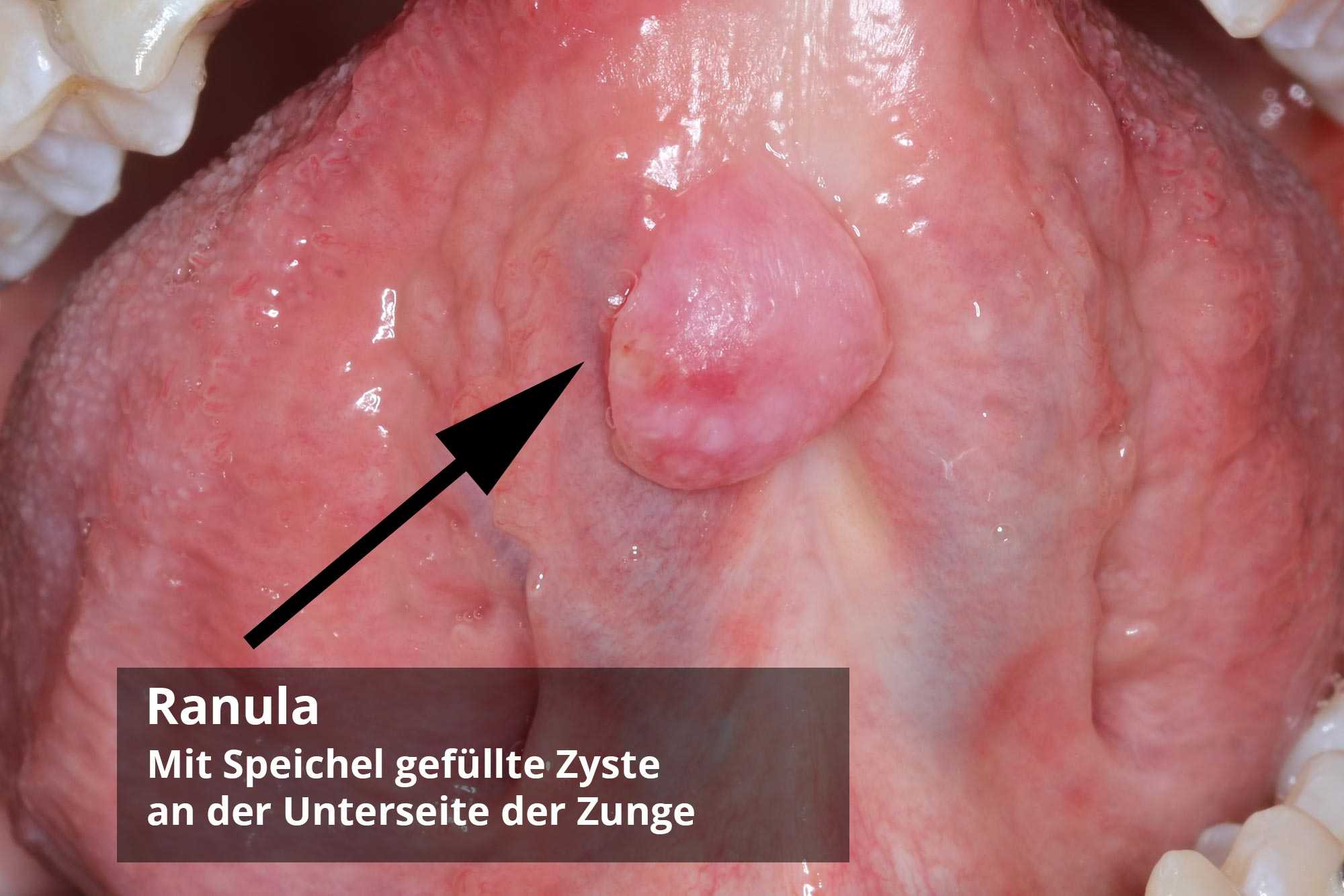 Knubbel auf der zunge
