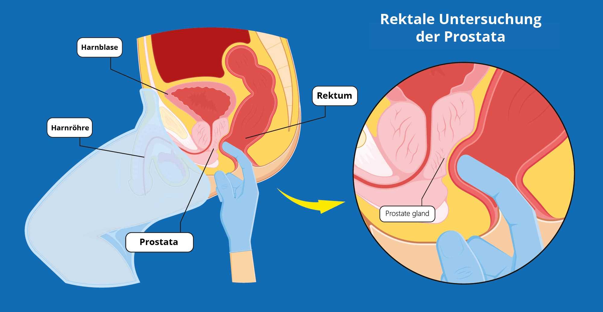durere în abdomenul inferior cu prostatita cronică