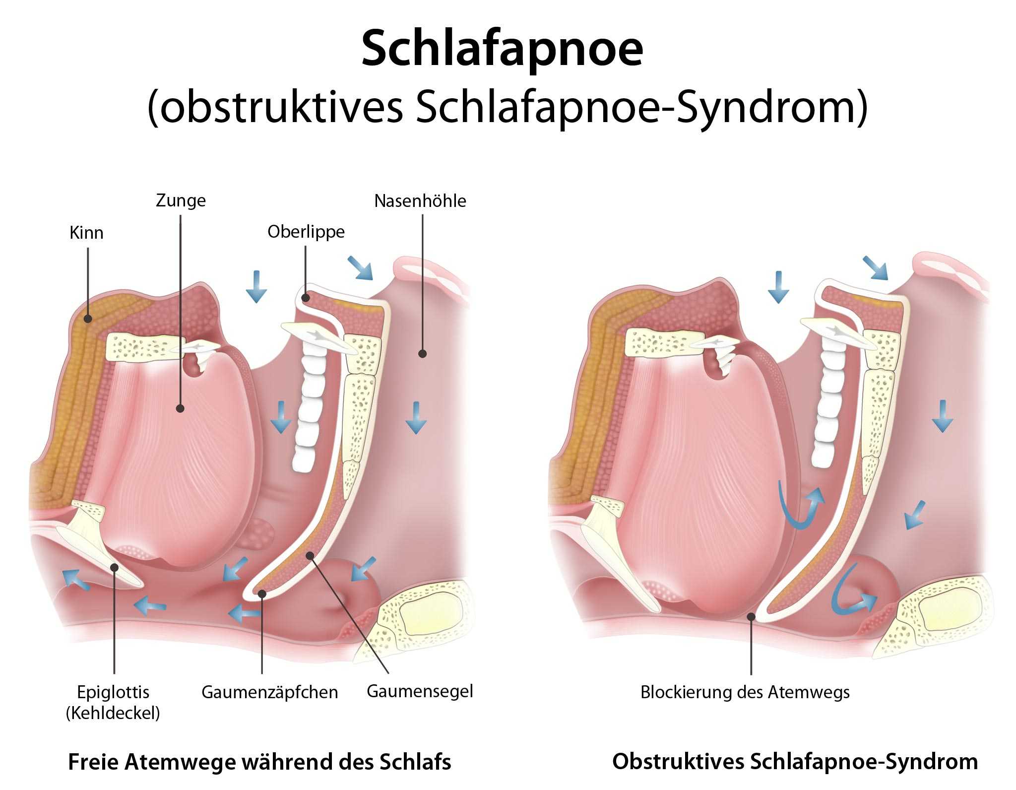 Das Obstruktive Schlafapnoe Syndrom WTQM