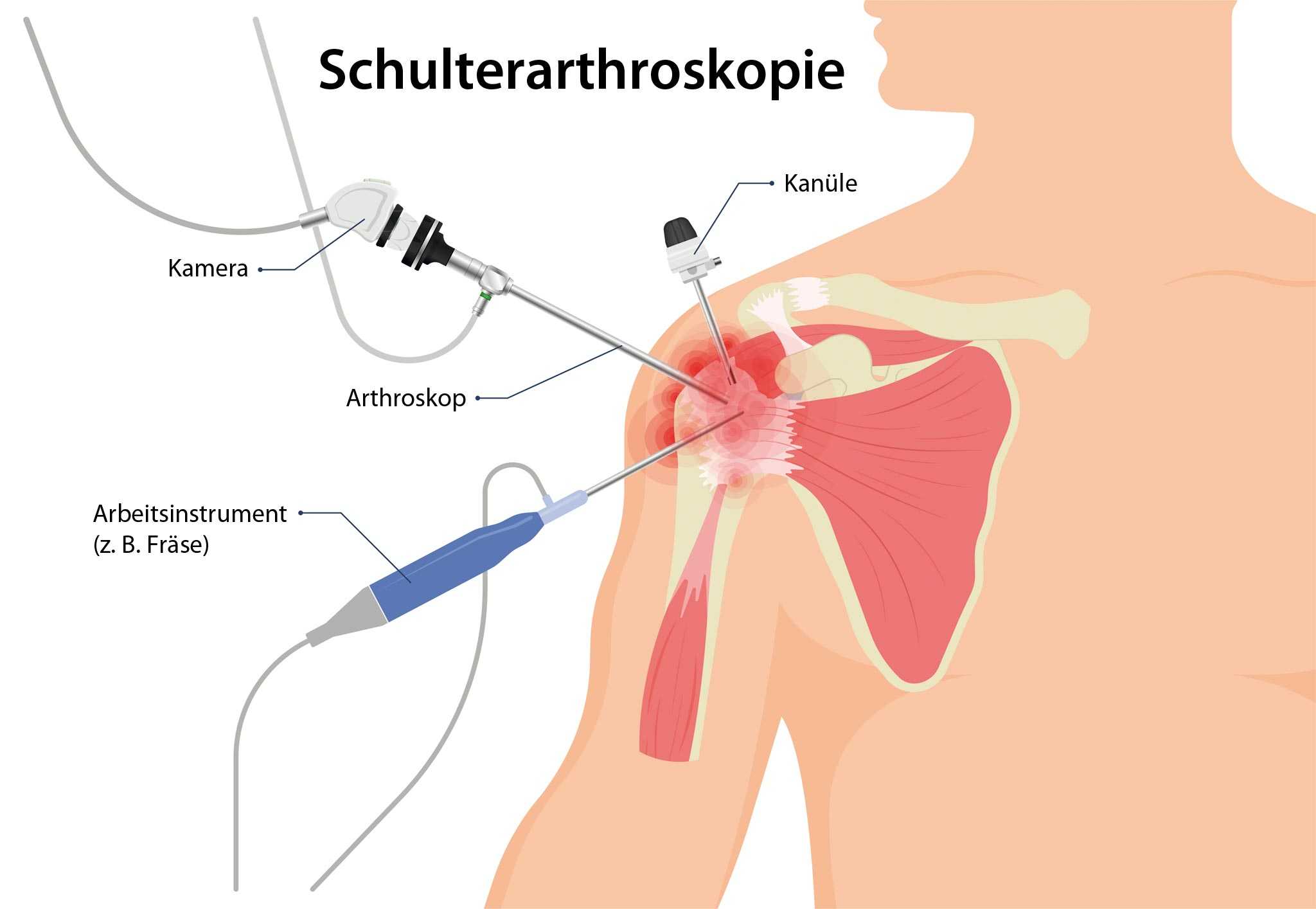 Wann und wie erfolgt eine Arthroskopie des Schultergelenks?