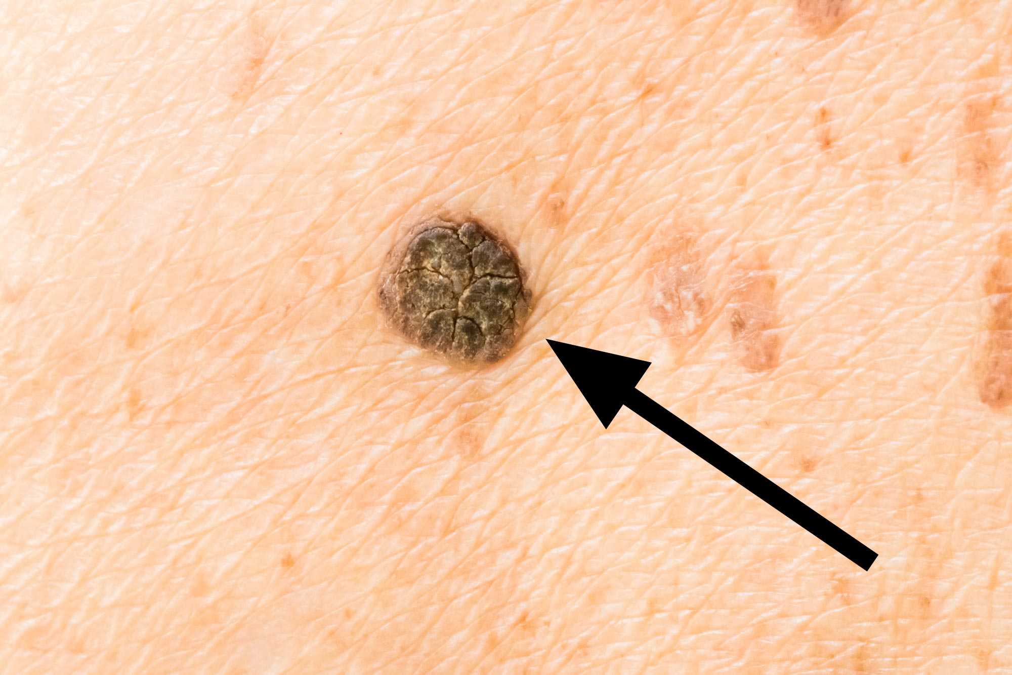 Schwarzem leberfleck punkt mit Schwarzer Hautkrebs