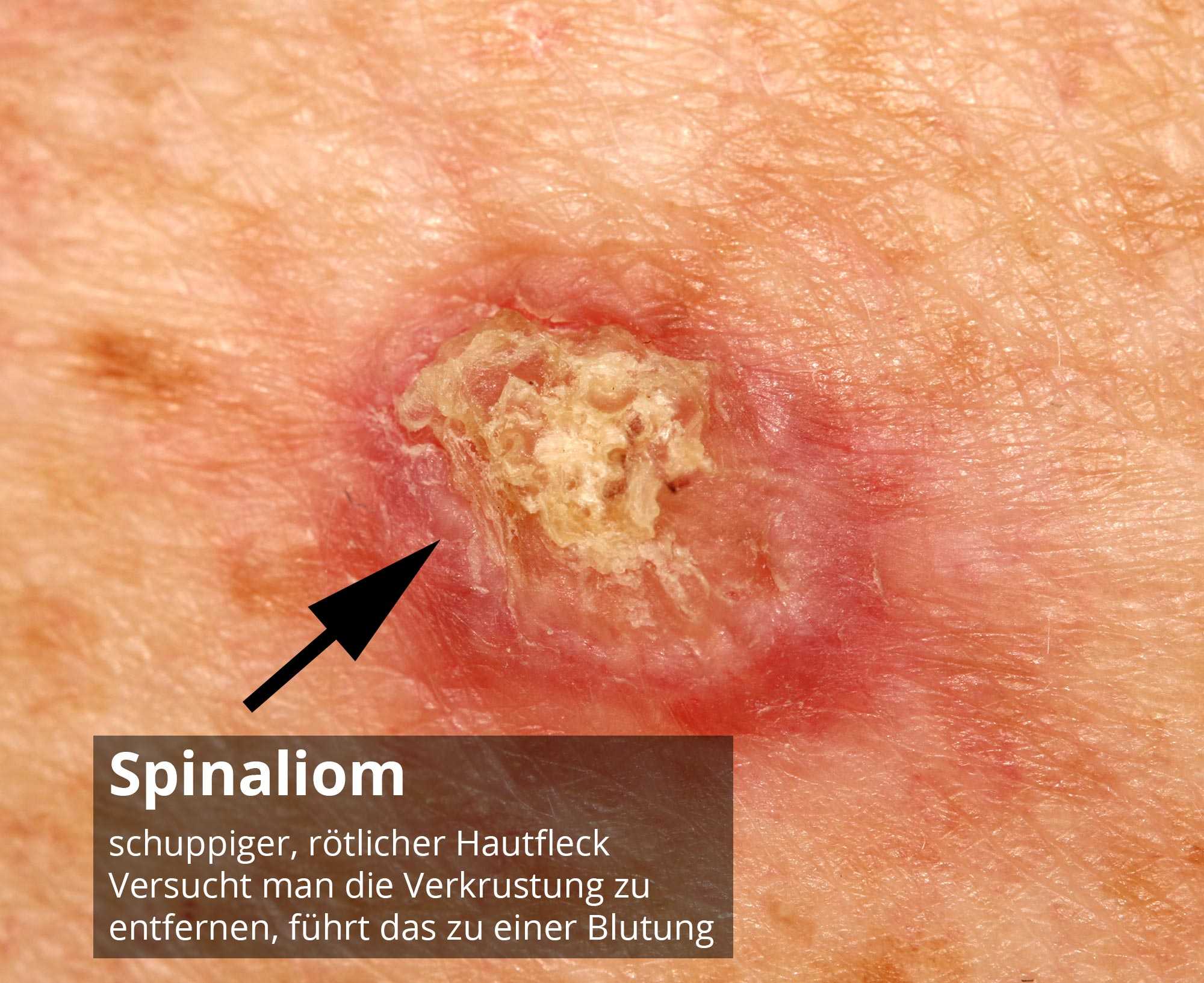 Unter der kugel haut harte Dupuytren