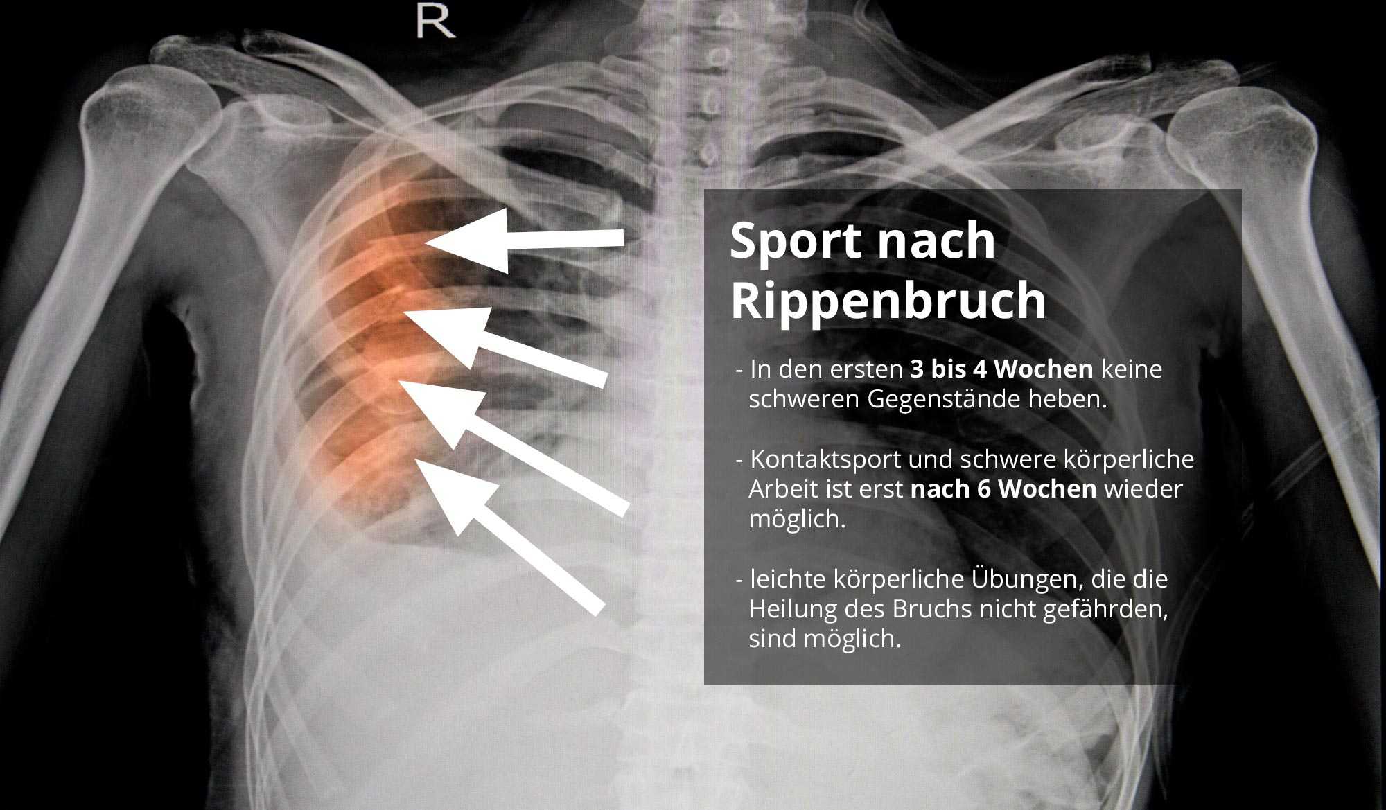 Oder gebrochen geprellt rippe Rippenbruch und