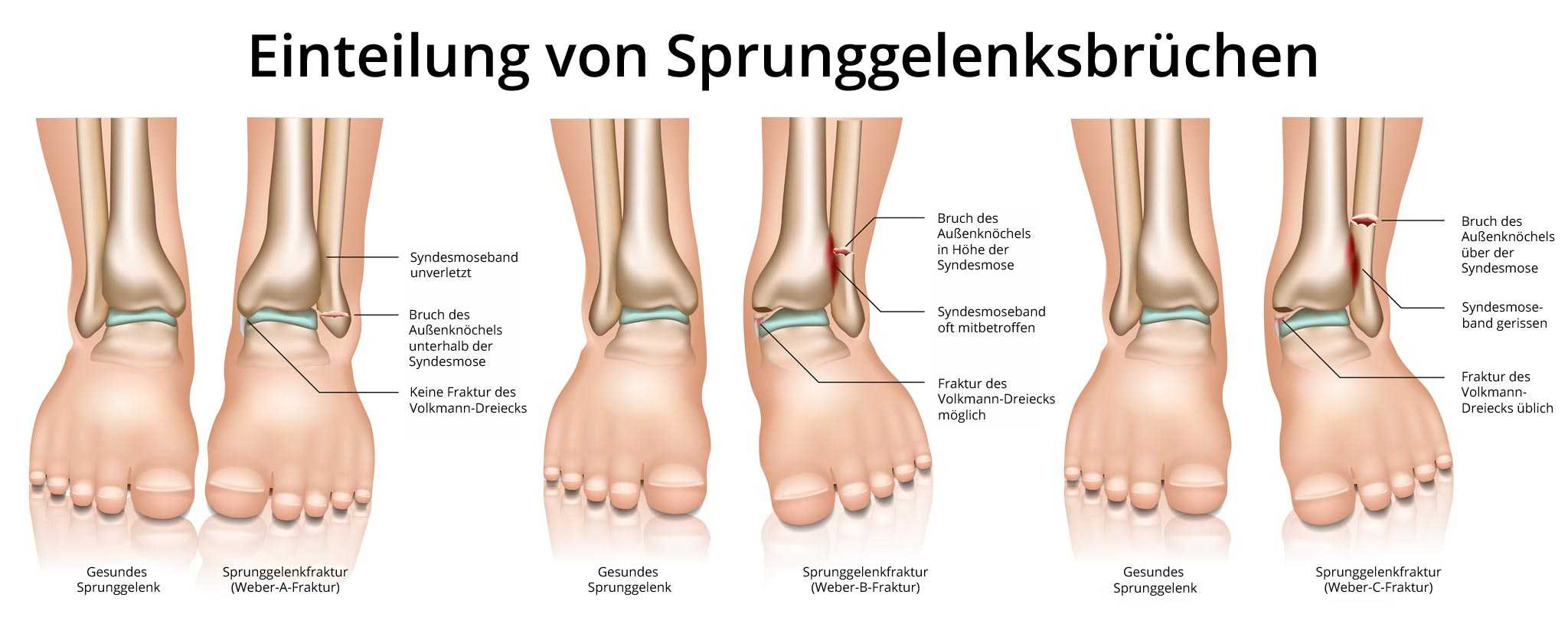 Gips lange gebrochen sprunggelenk wie Wie lange