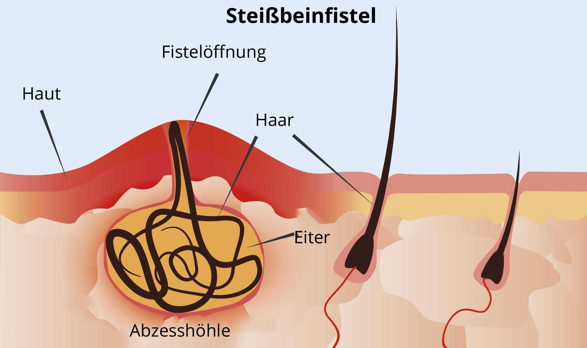 Eingewachsenes haar tief 🏥 Eingewachsene