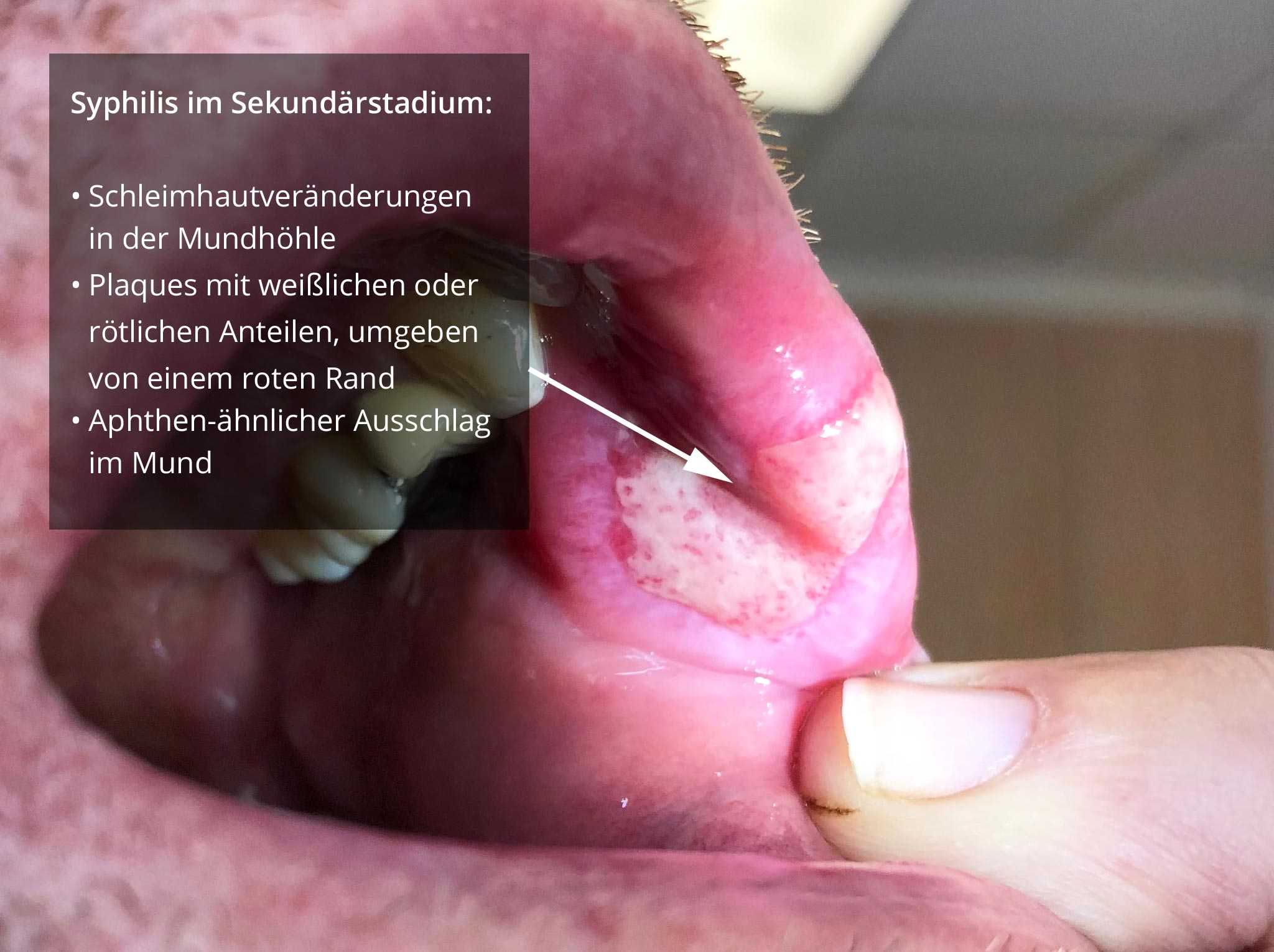 Wie äußert sich knochenkrebs Wie äußert sich knochenkrebs