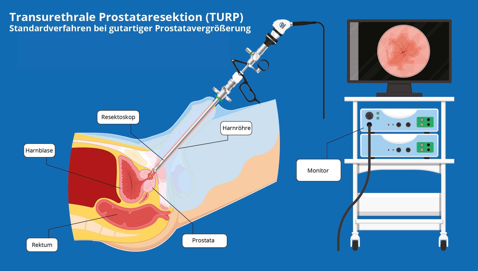 Transurethrale resektion