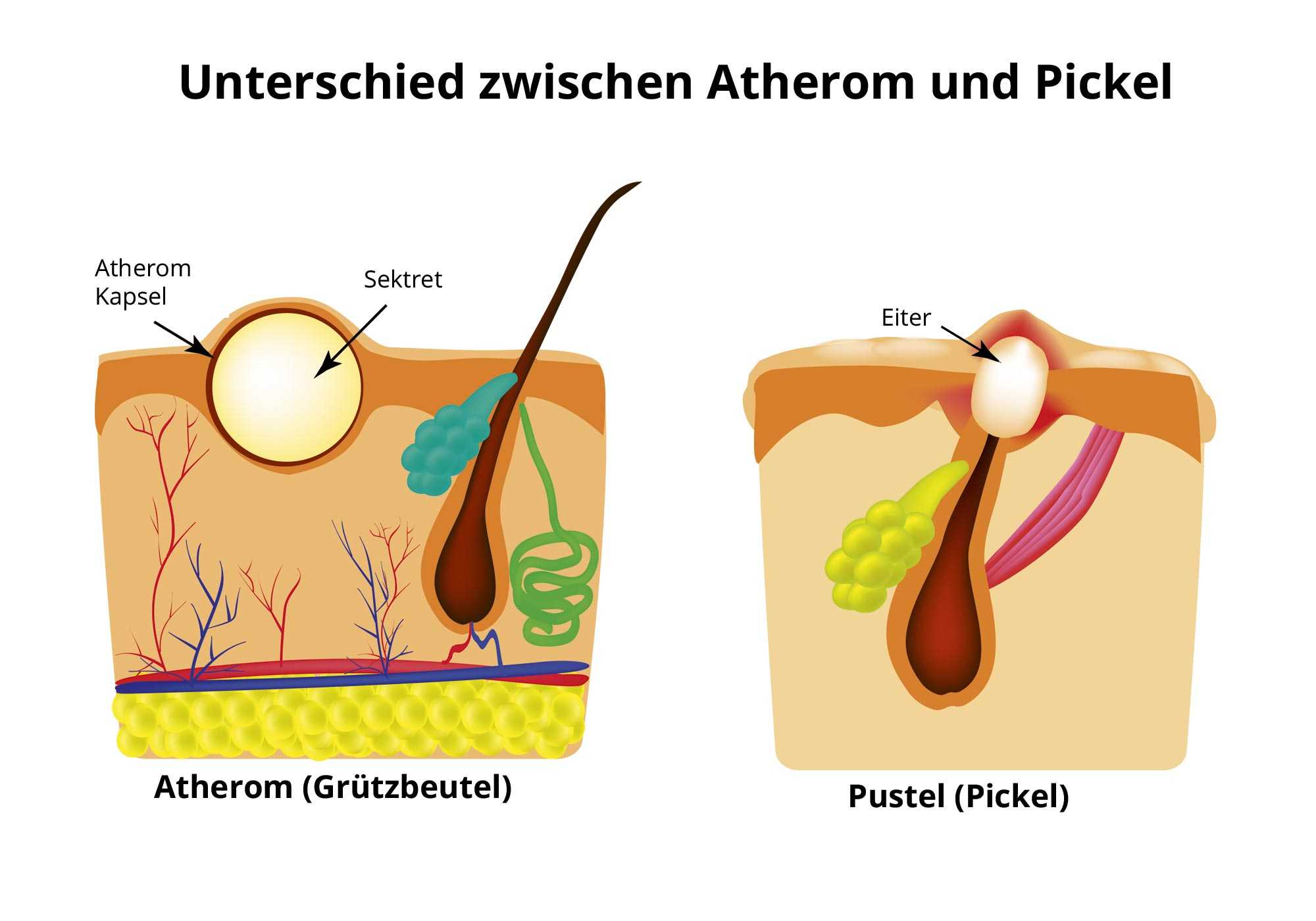 Haut - Dermatologie. ©. Unterschied zwischen Atherom und Pickel. 