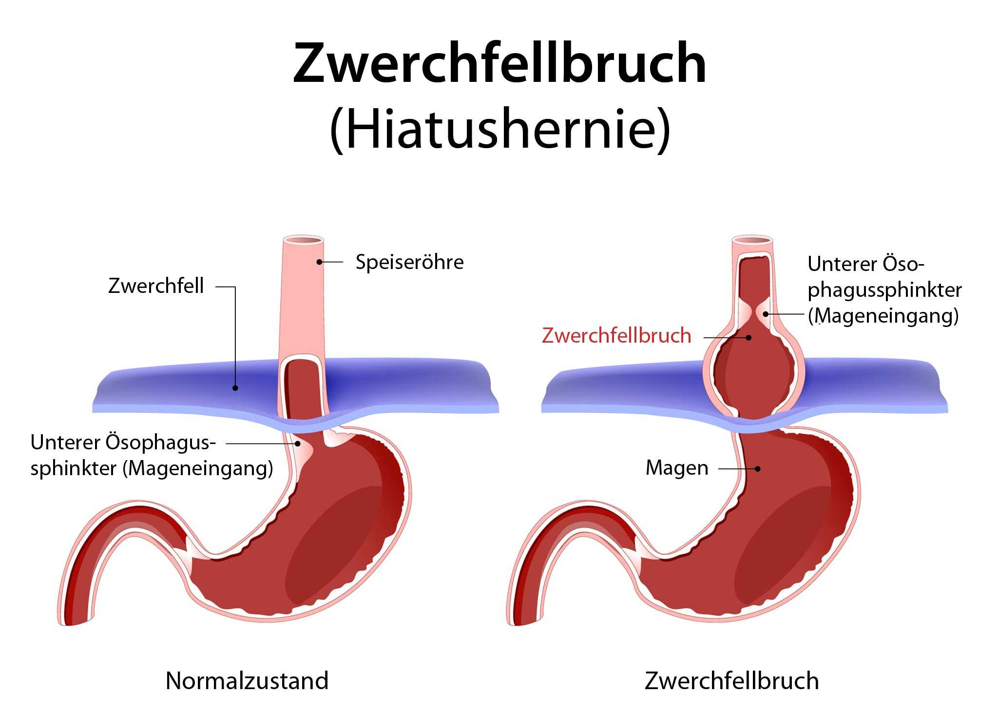 Zwerchfellbruch (Hiatushernie). 